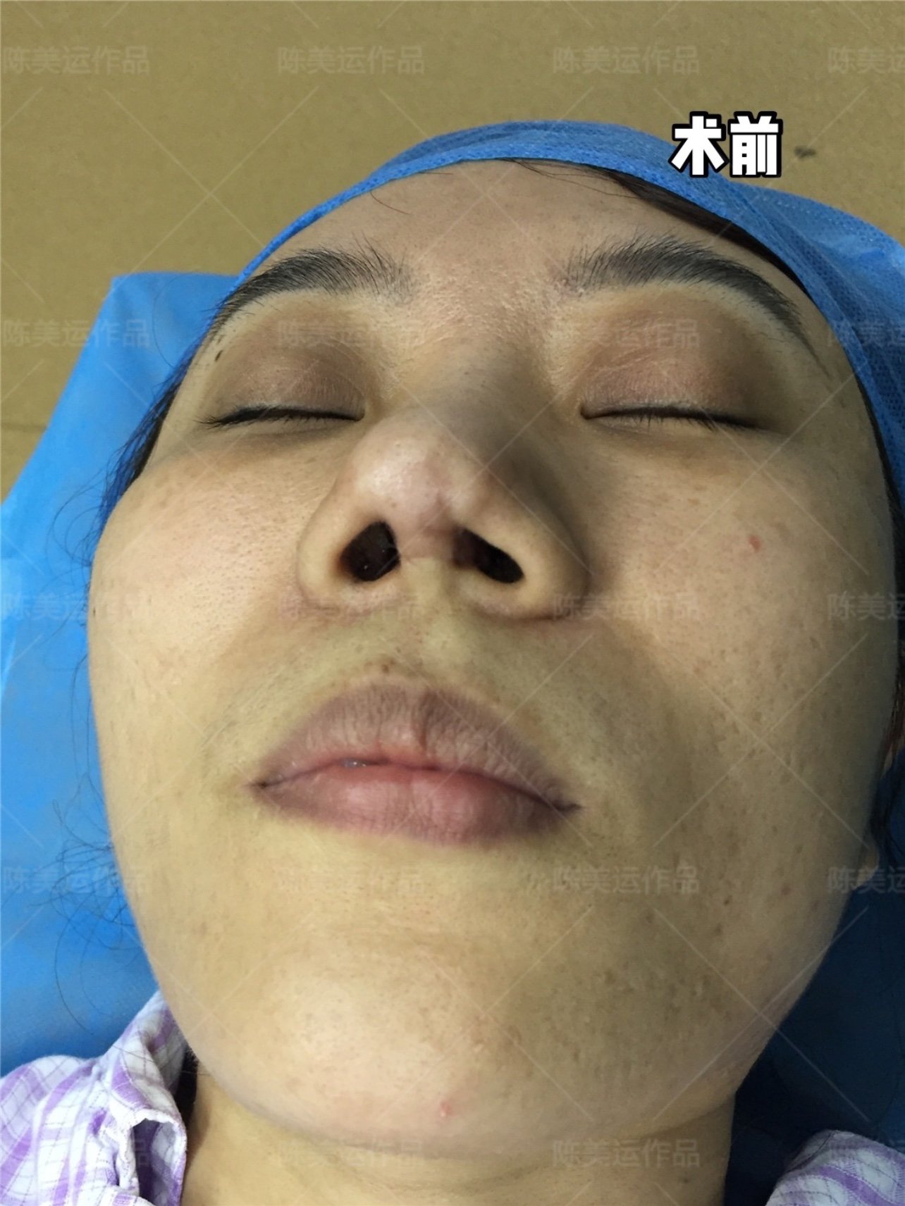 鼻整形术后严重疤痕增生该如何修复