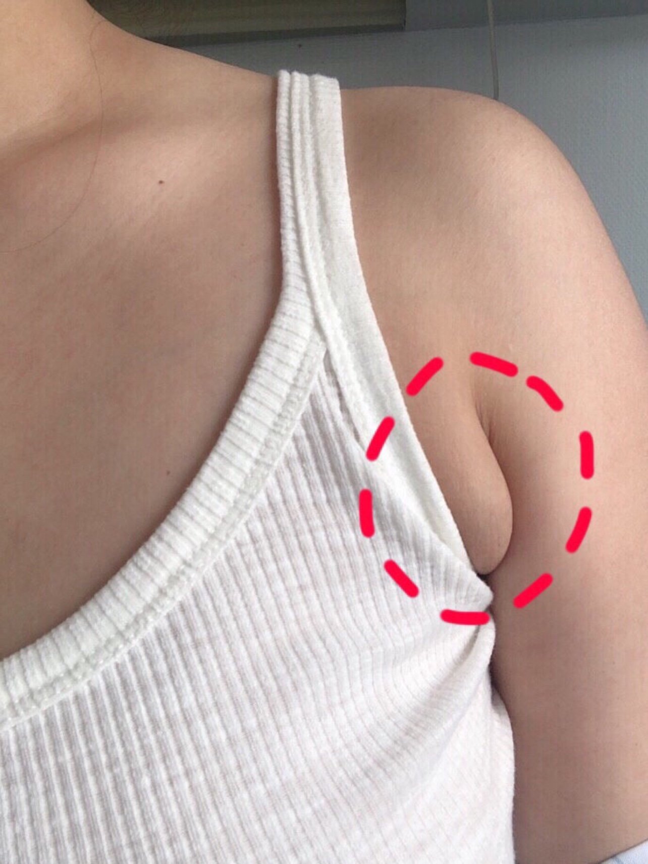 副乳正常照片 乳腺图片