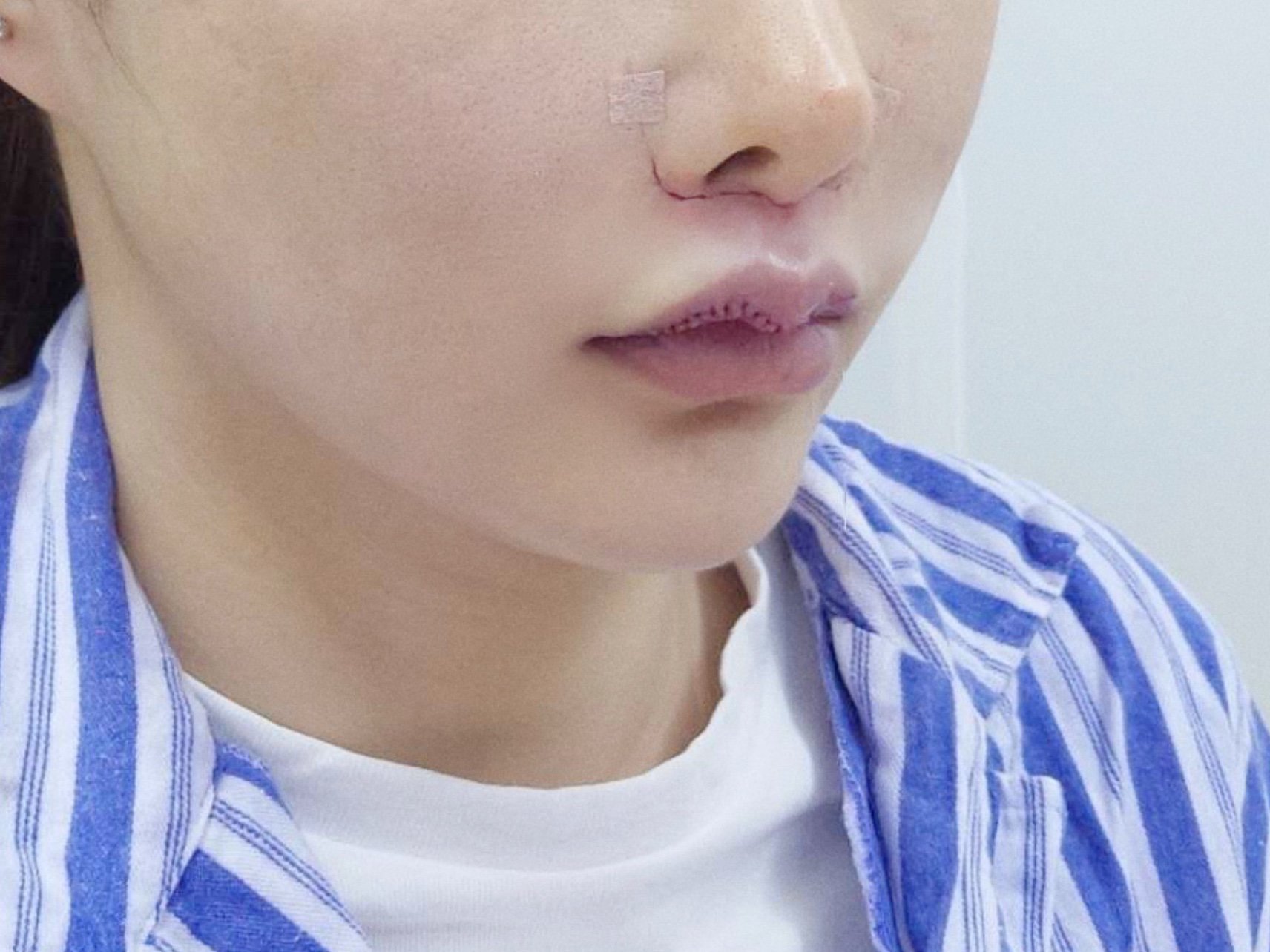 我的人中不是天生长的,做完鼻子之后就感觉看上去长了_圈子-新氧美容