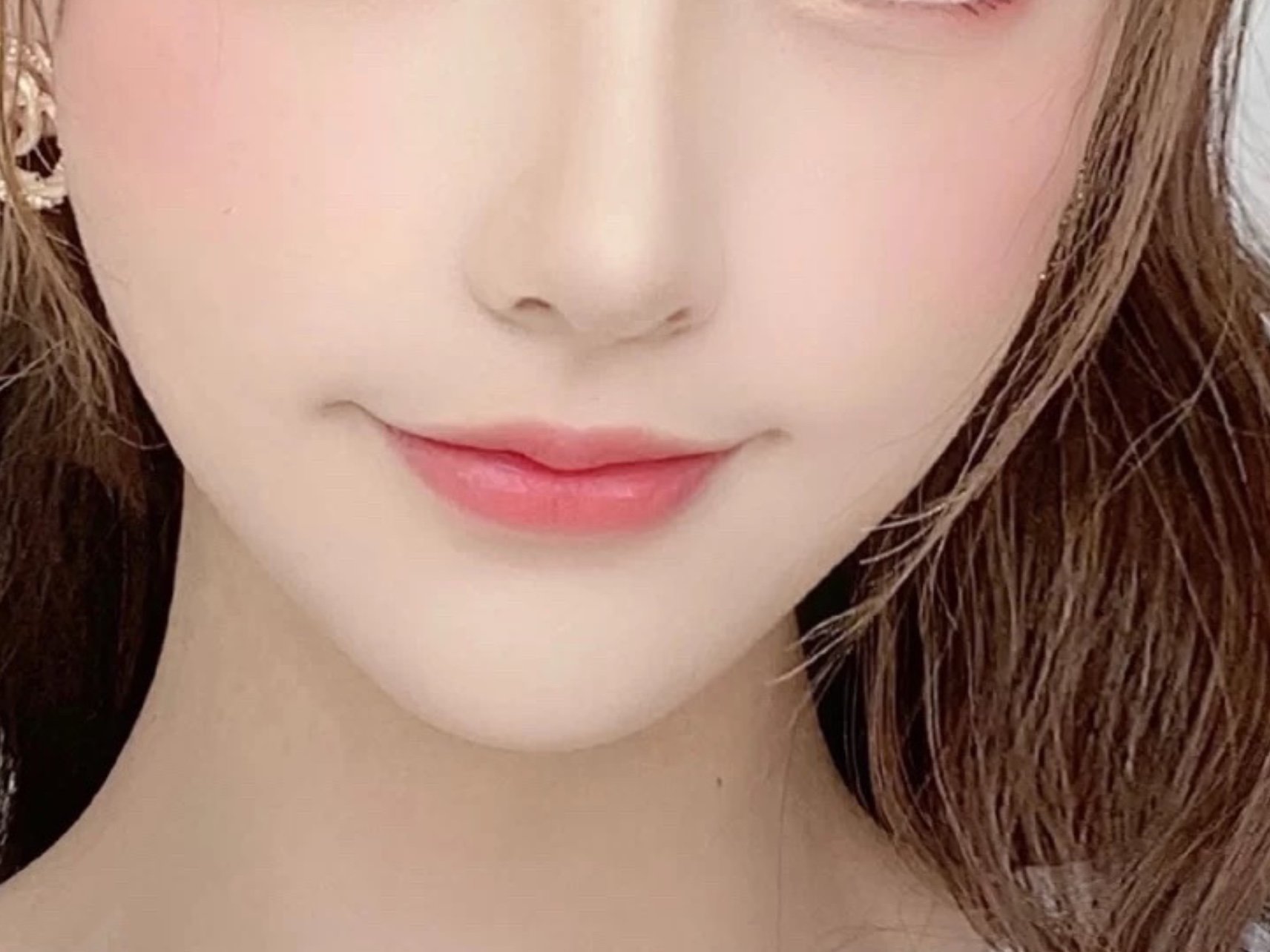 做了唇部手术有两个月了,微笑唇跟m唇的效果都有,不_圈子-新氧美容