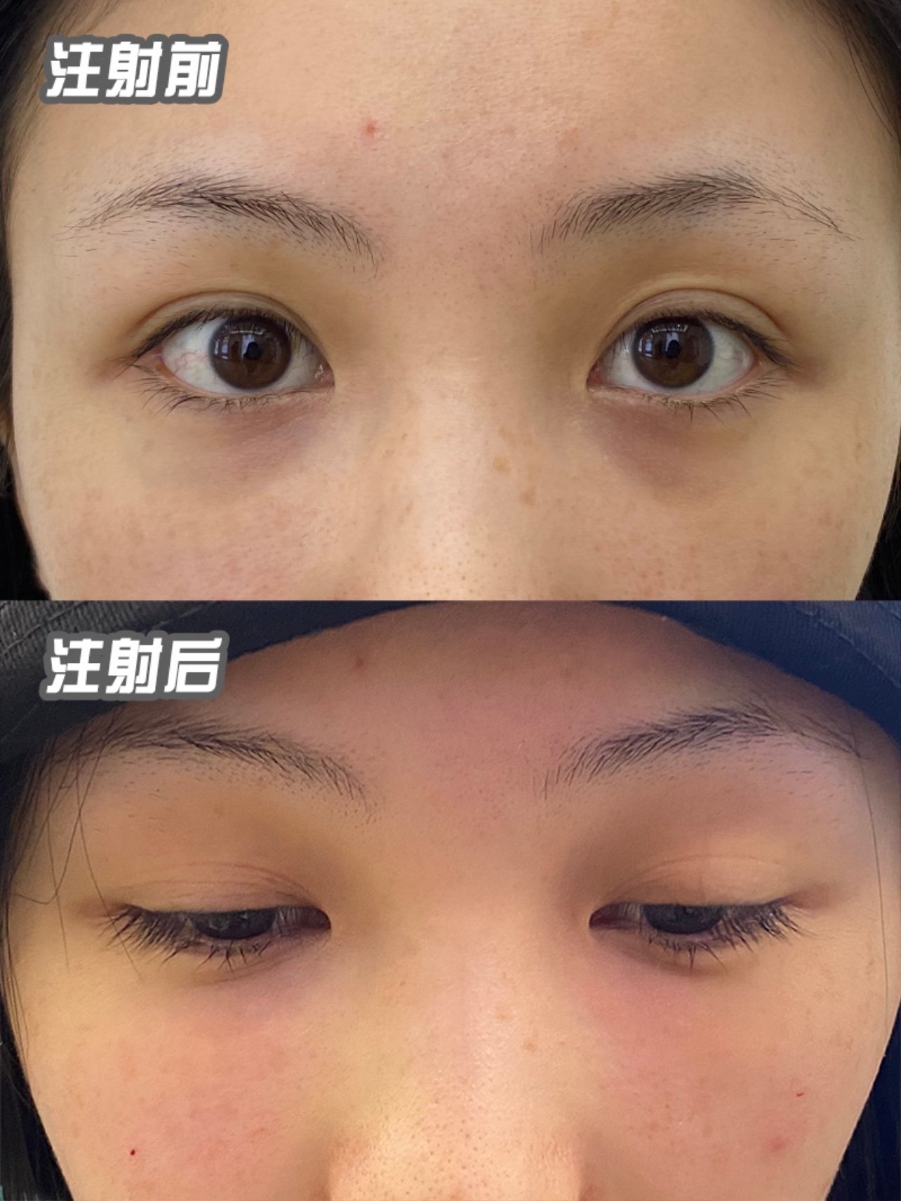 双美胶原蛋白填充泪沟案例分析