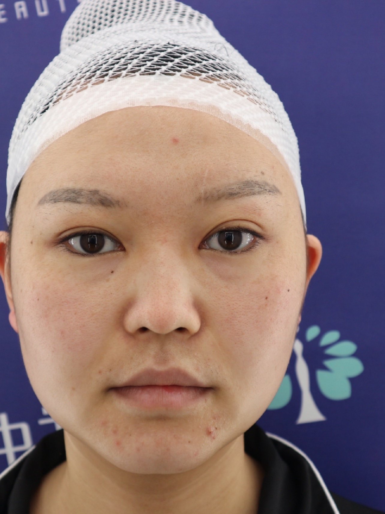 脸大肉多的小鼻子鼻部多项手术后脸型都变了