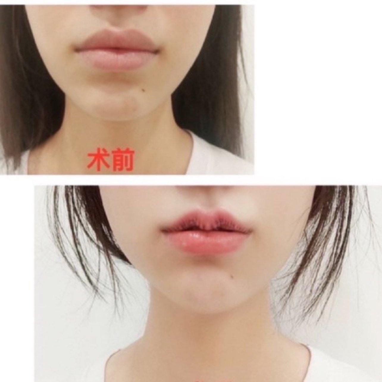 做的15800的套餐,内切嘴角上扬加m唇,对m唇的_圈子-新氧美容整形