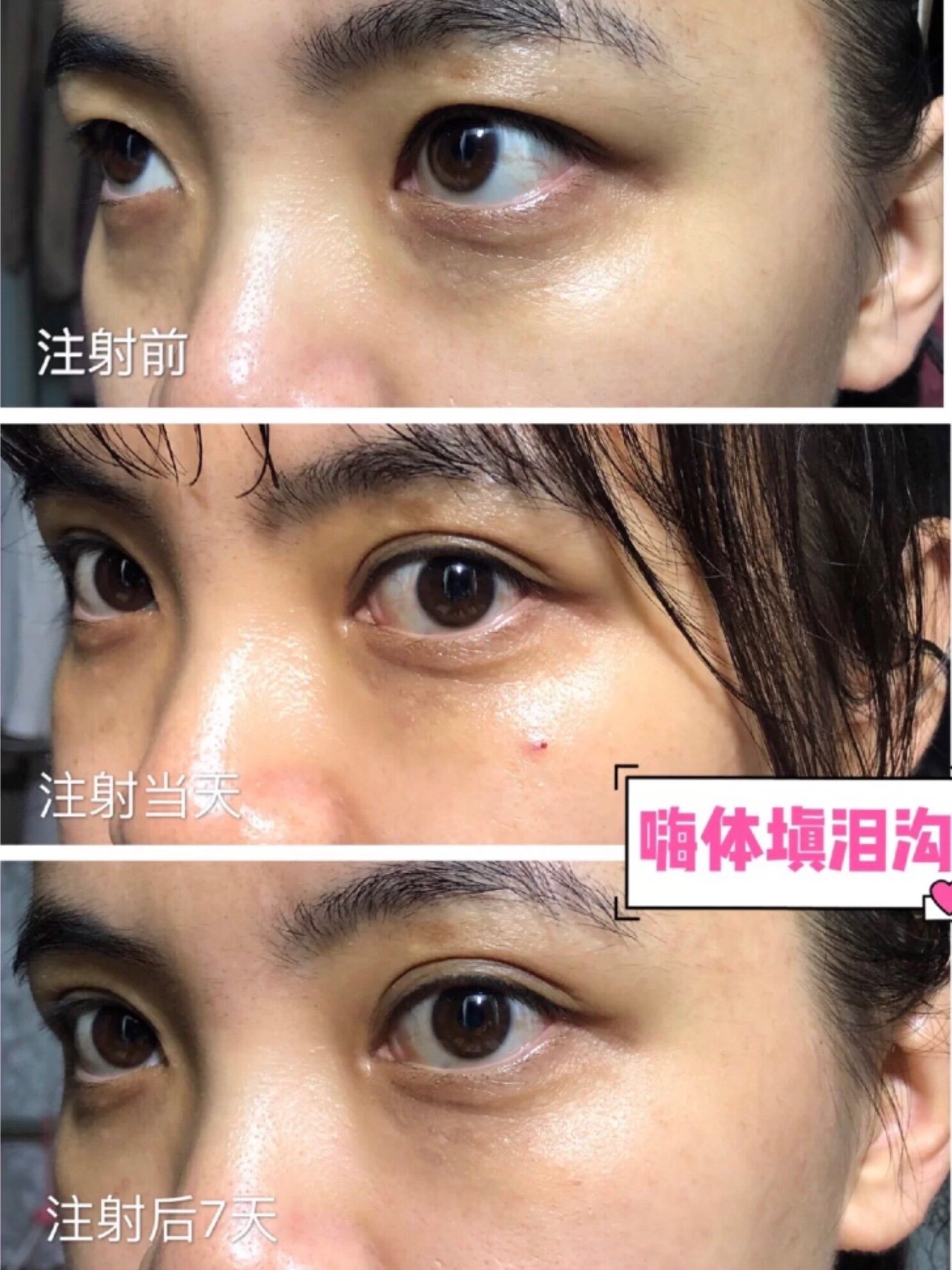 嗨体填充泪沟和眼窝的效果如何呢?