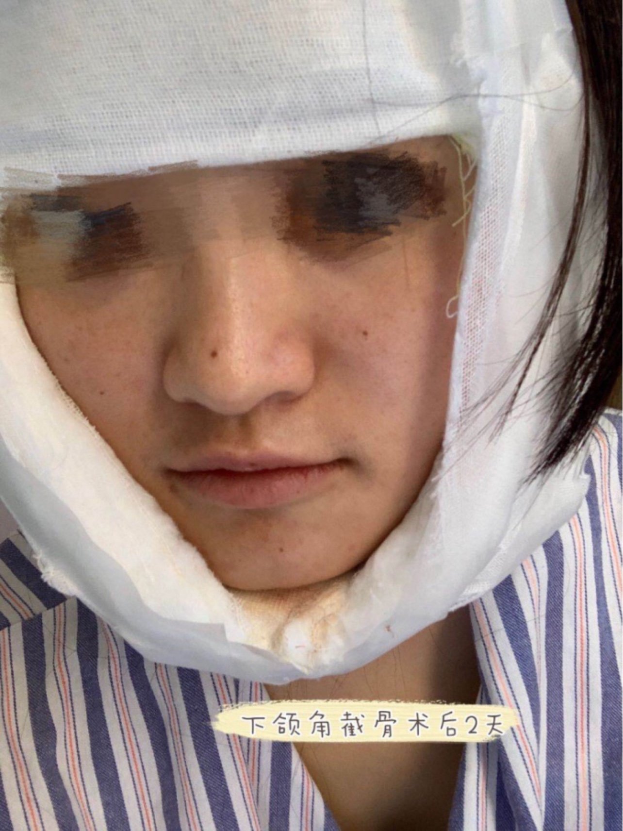 下颌角截骨术后5天效果!