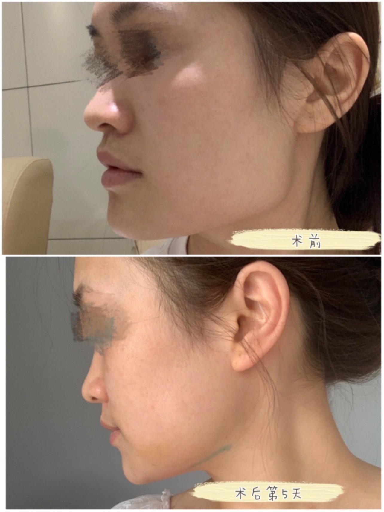 下颌角截骨术后5天效果