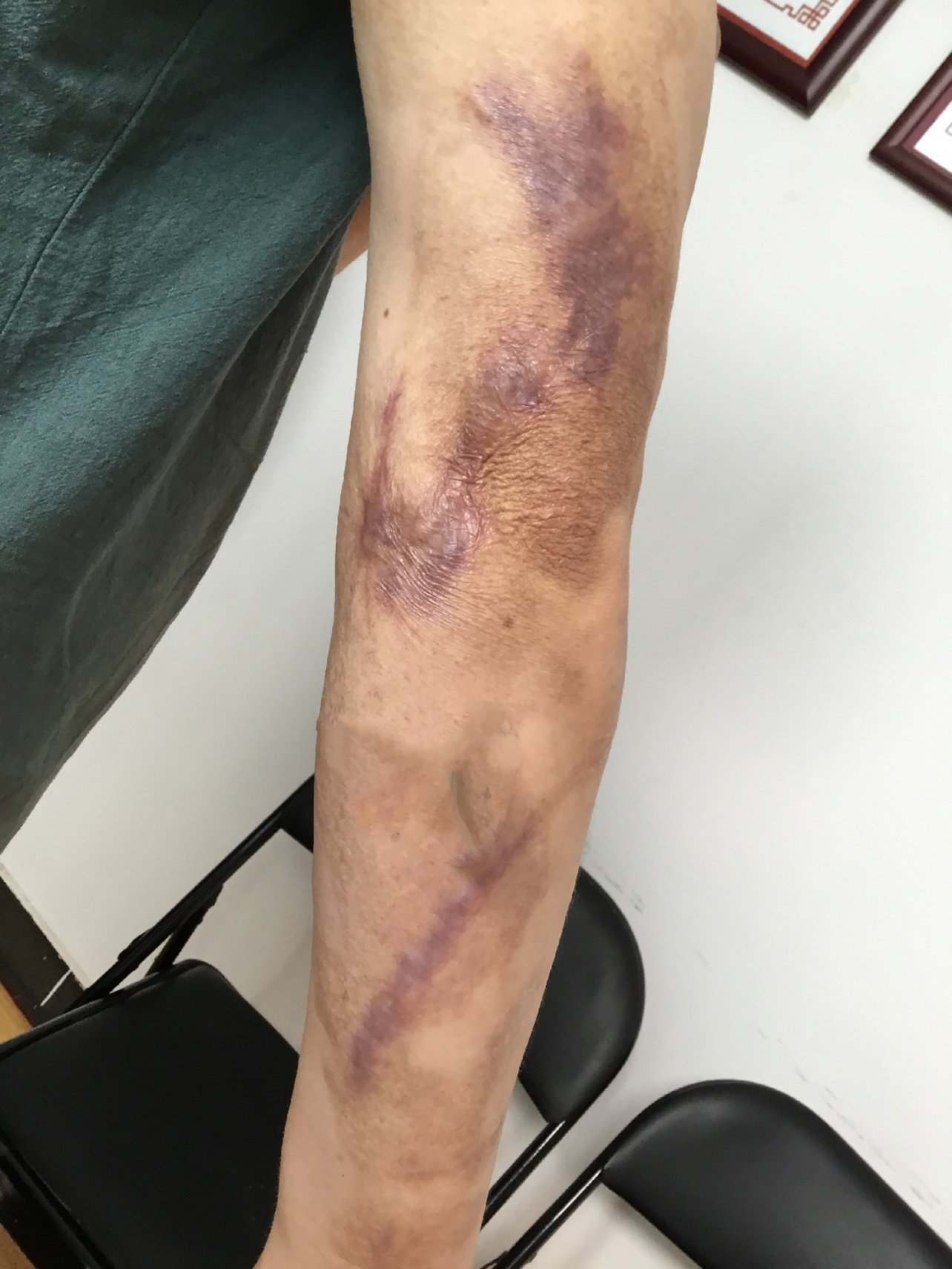 经过60天的治疗,胳膊上的伤疤明显的变小很多,要不_圈子-新氧美容整形