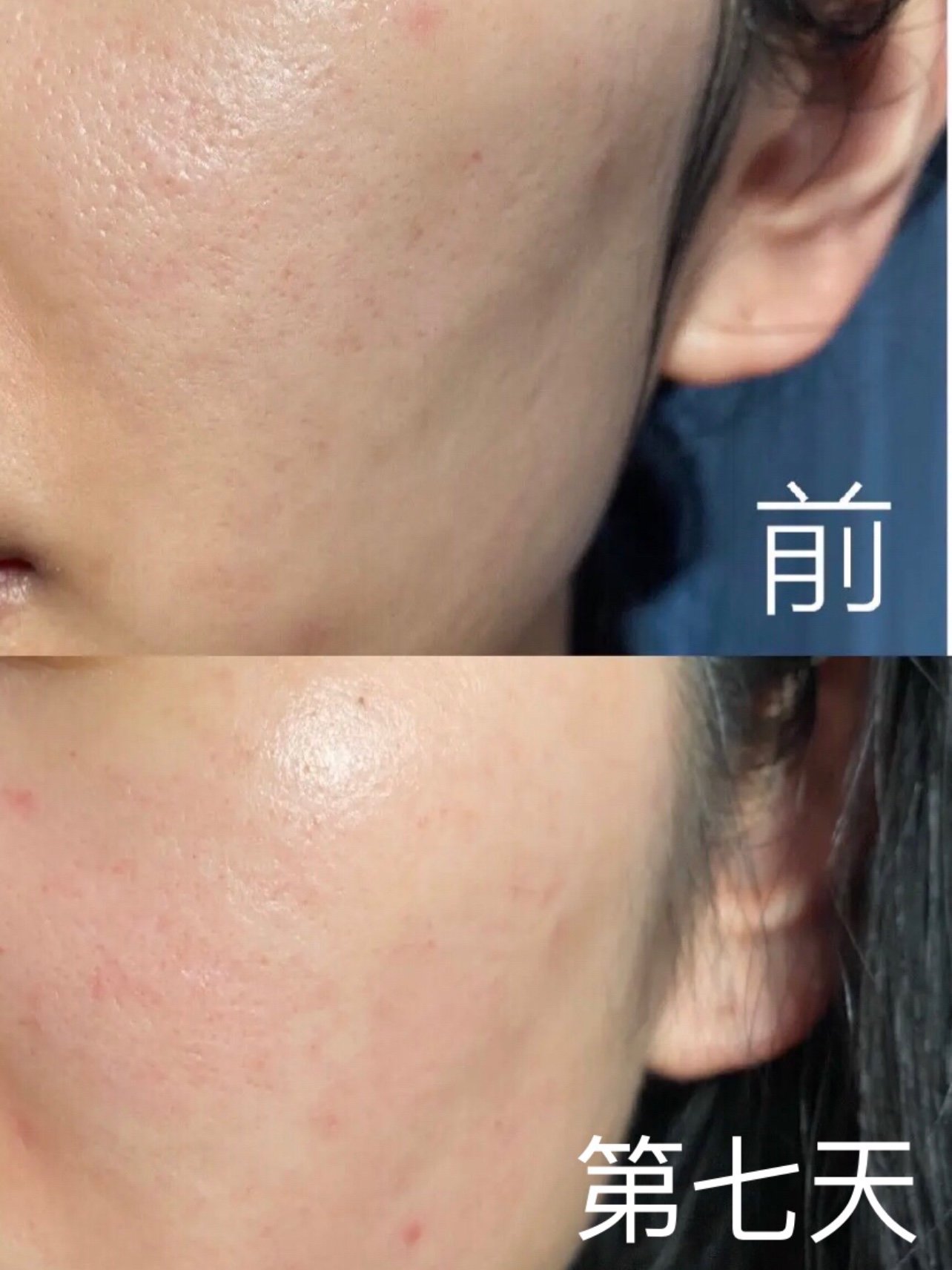今天是做完可丽金微针的第7天,皮肤好多啦,在恢复有变白亮通透.