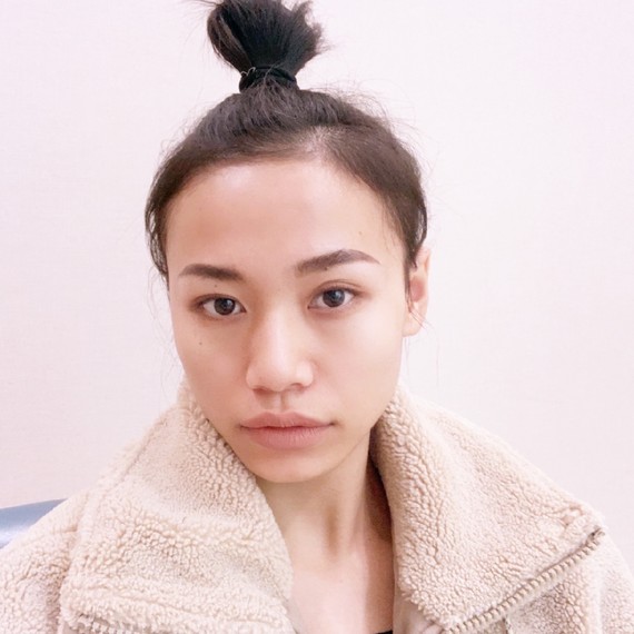 看看我术前的大额头,其实都是因为鬓角毛发太少了,有_圈子-新氧美容