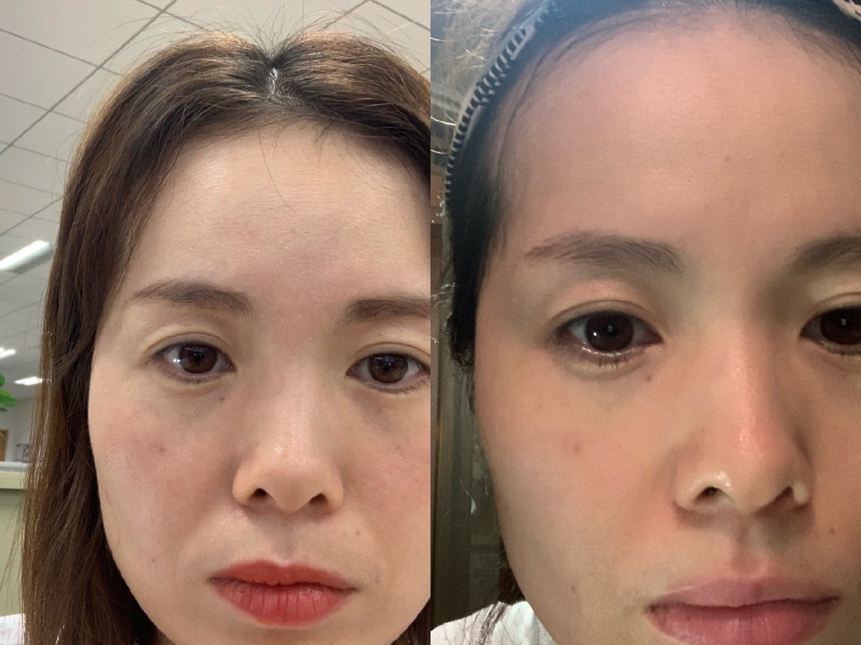 续上热拉提后一月:对比术前术后一月的照片发现法令纹_圈子-新氧美容