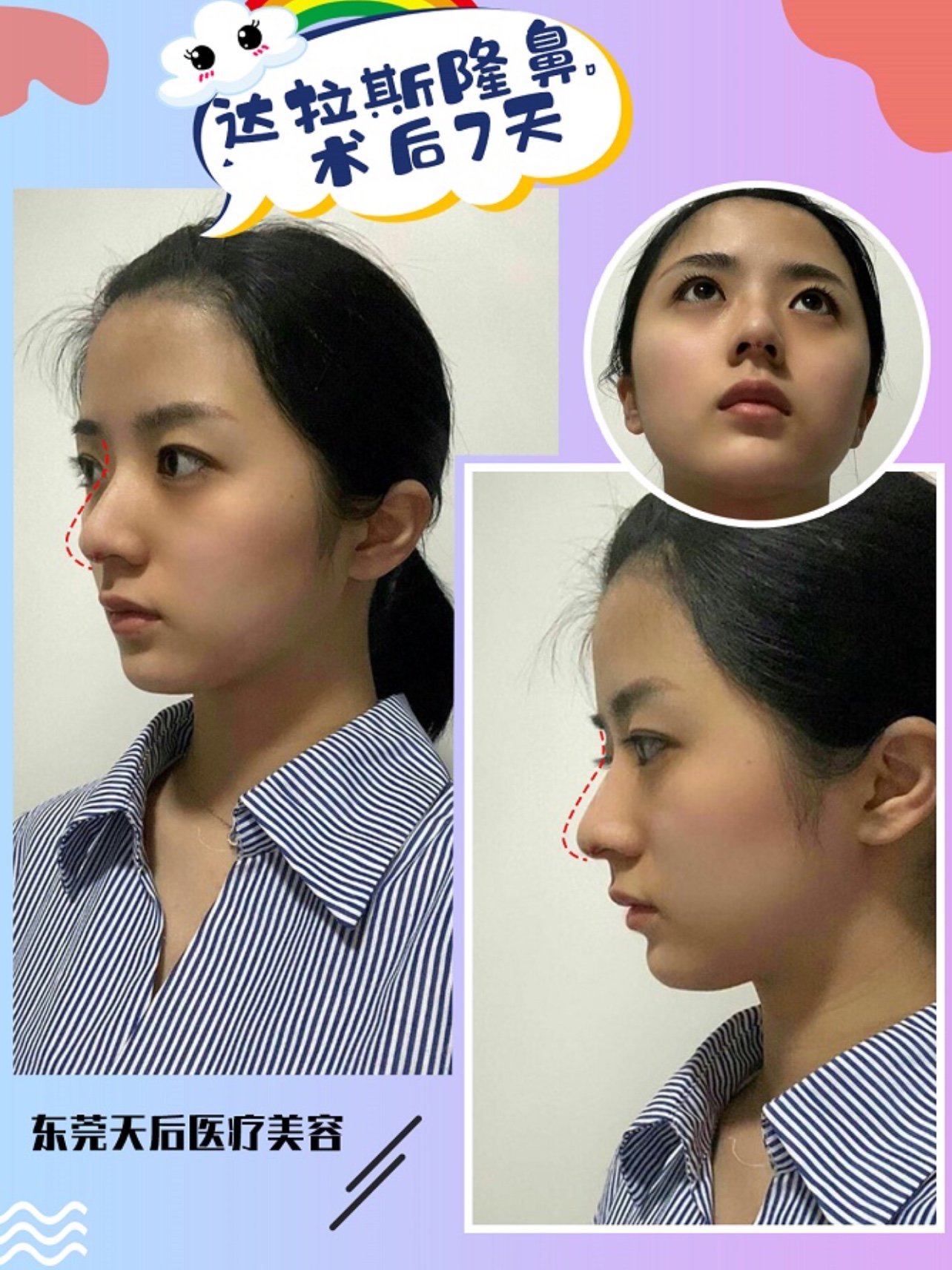 【达拉斯隆鼻第7天】今天拆线啦,你说也奇怪没做之前_圈子-新氧美容