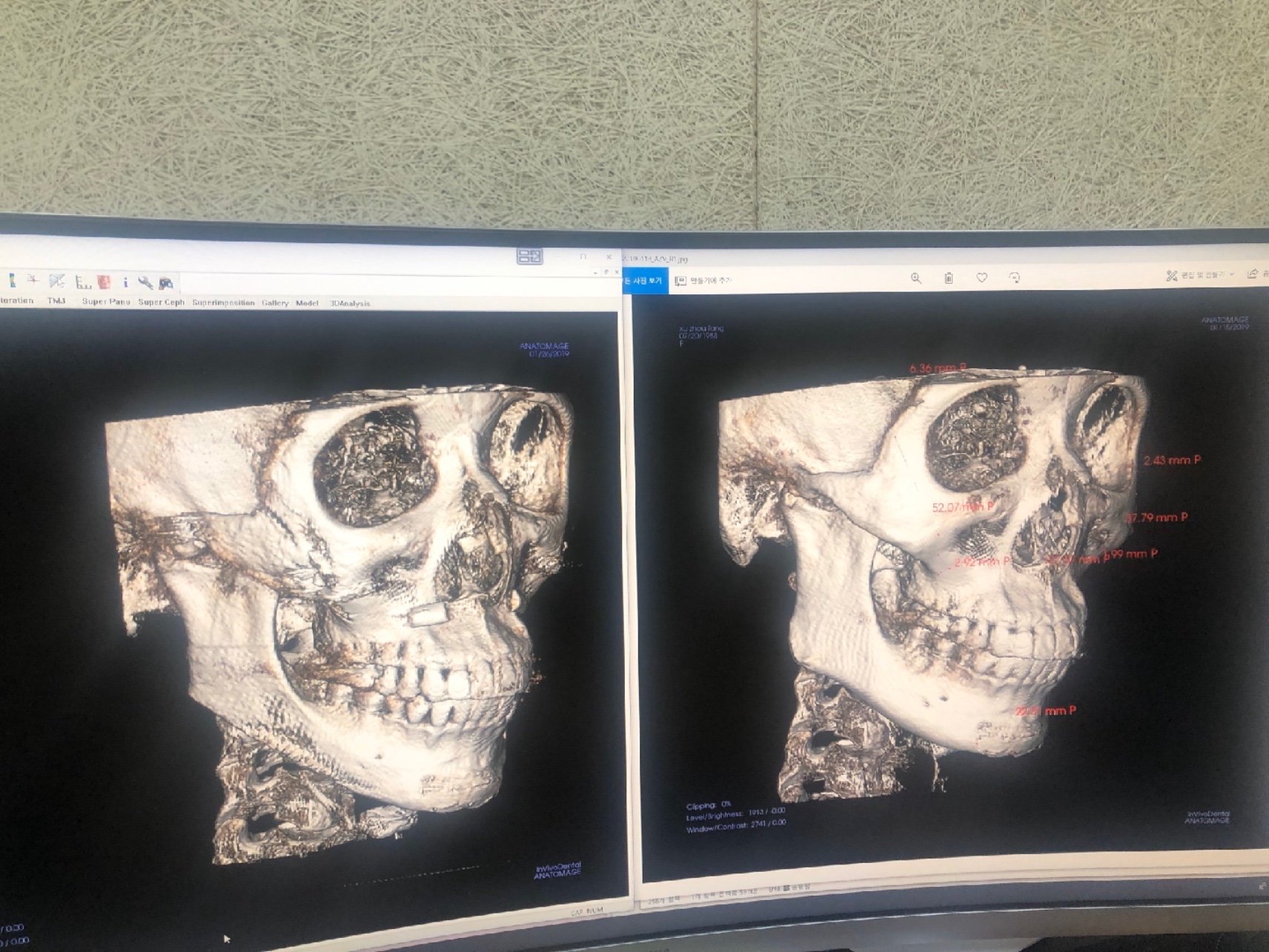 做完轮廓手术快2年了,整体还是非常满意的.ct片子_圈子-新氧美容整形