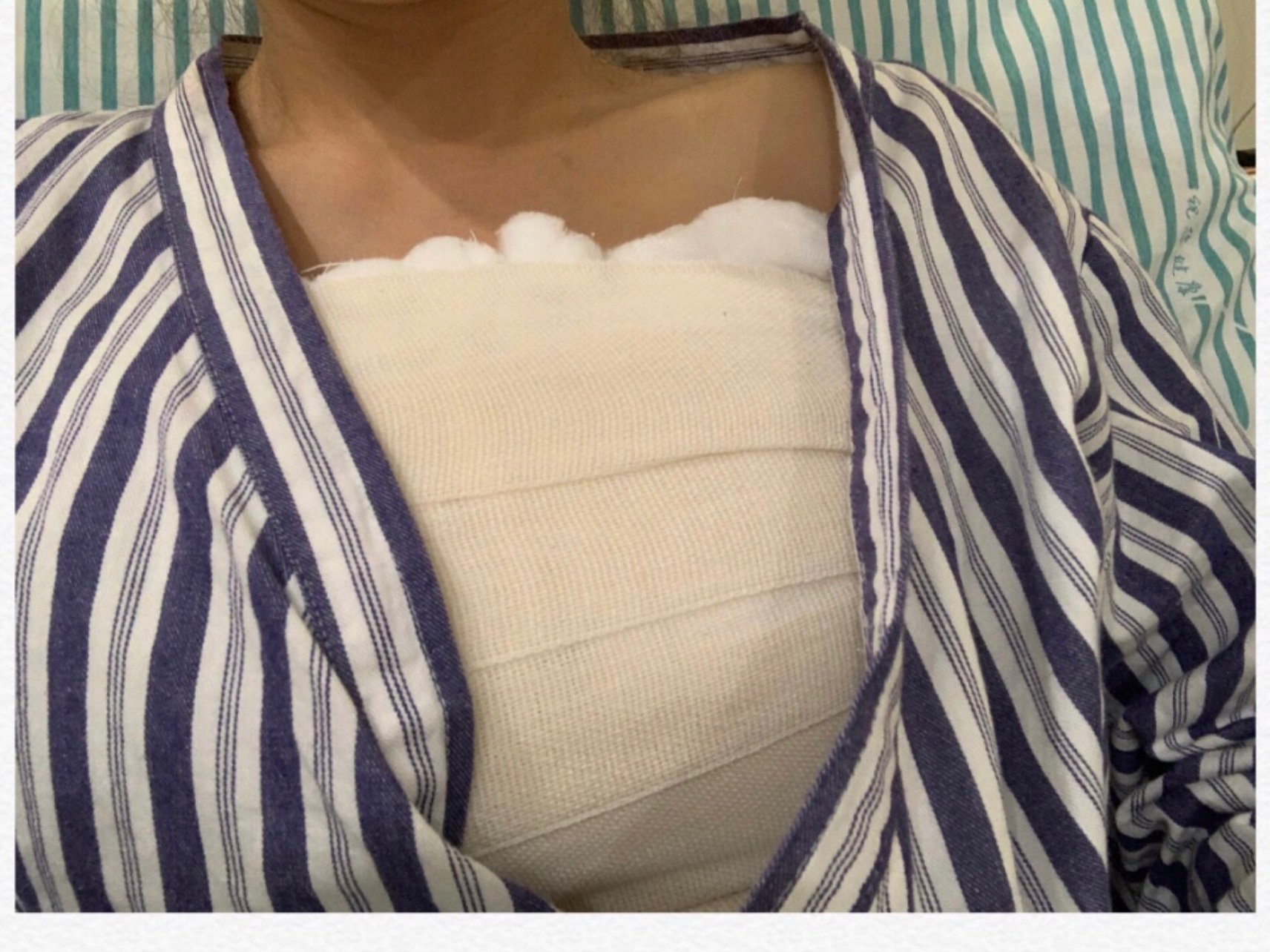 今天是做完手术的第一天,现在胸是用纱布裹起来的,因_圈子-新氧美容