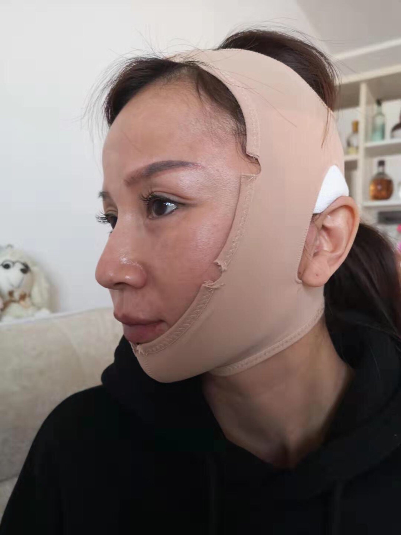 今天是做小切口拉皮的第1天,整体感觉还好,除了张嘴_圈子-新氧美容
