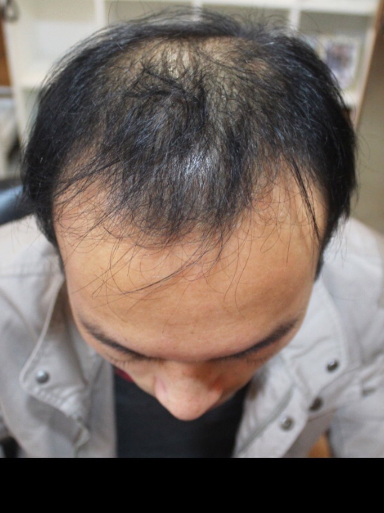 近些年以来也不知道什么情况导致脱发面积比较大.