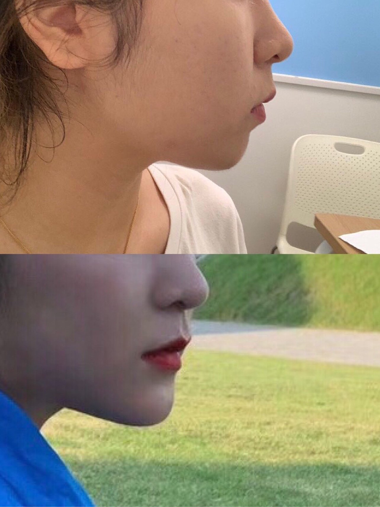 【术前诊断】:求美者之前有下巴后缩的问题,侧面拍照_圈子-新氧美容