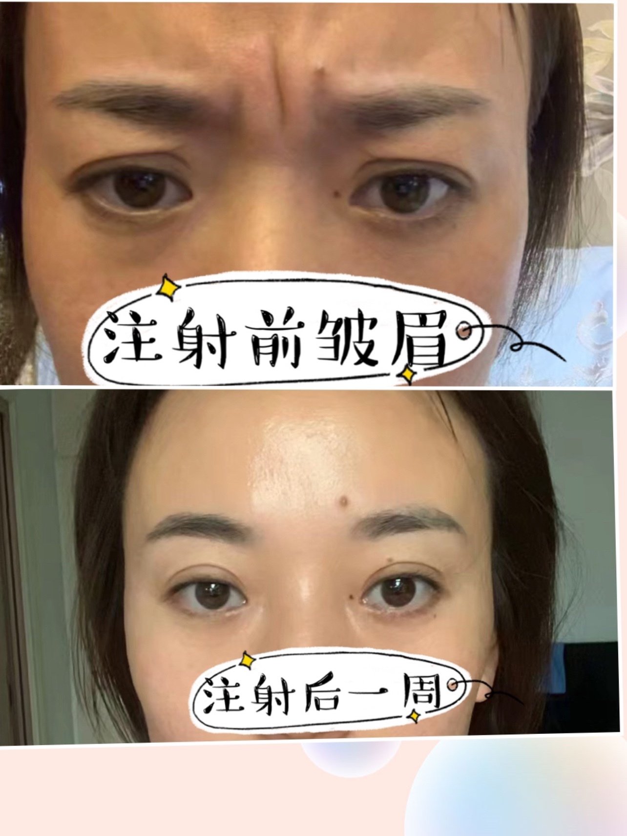 7816615眉间纹也叫川字纹,从小就有眉间纹,眉心有一_圈子-新氧