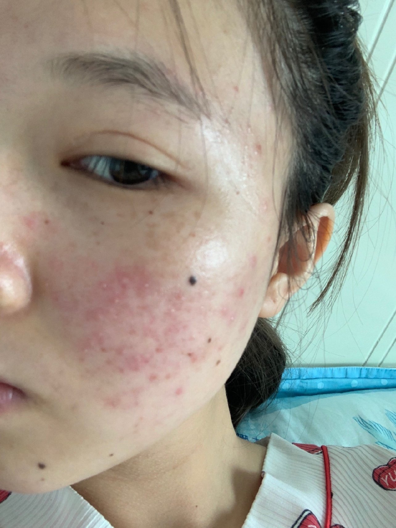 屏障受损一直泛红长痘长闭口的该怎么办才好