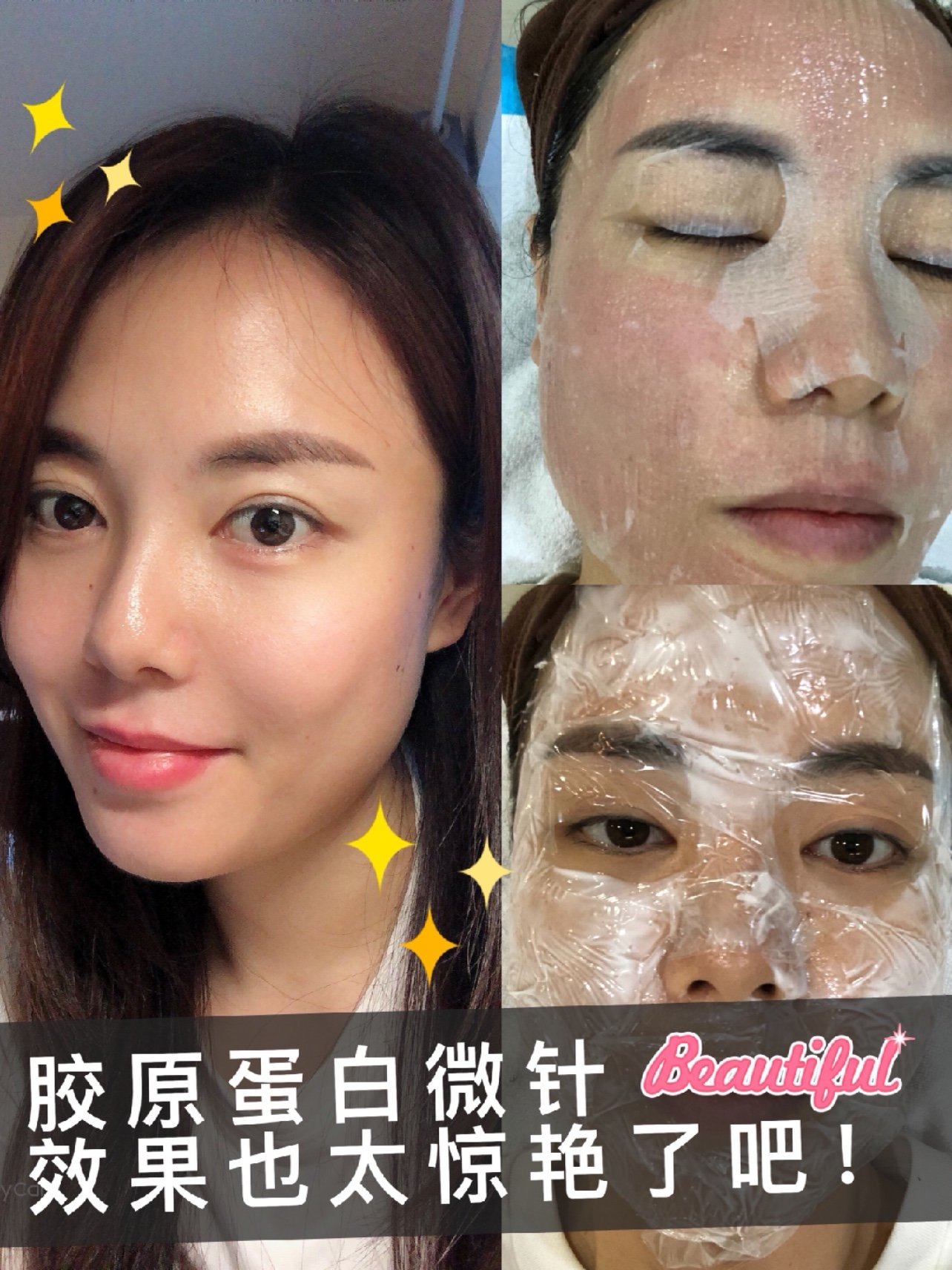 【胶原蛋白微针】皮肤细腻又弹润,给你真正少女肌!