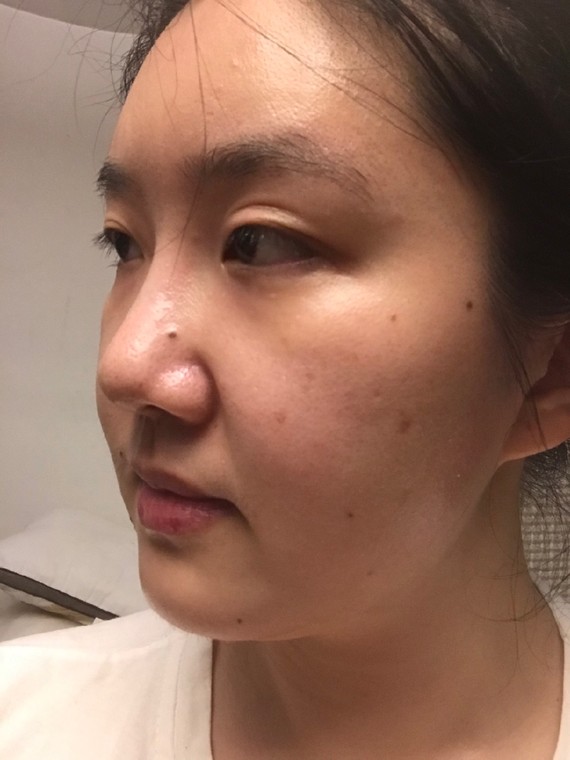 结果左眼变成了这样00突出一块没法化妆没法贴双眼皮贴,不知道是