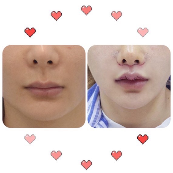 第7天过来拆m唇的线