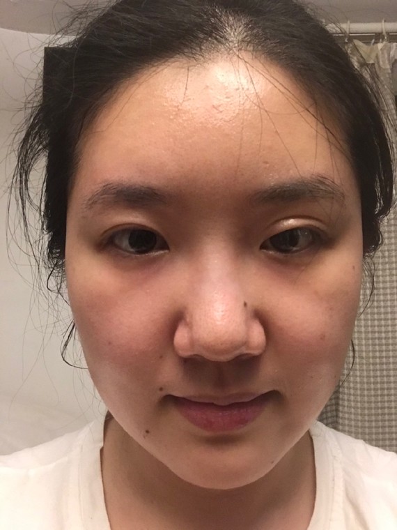 结果左眼变成了这样00突出一块没法化妆没法贴双眼皮贴,不知道是