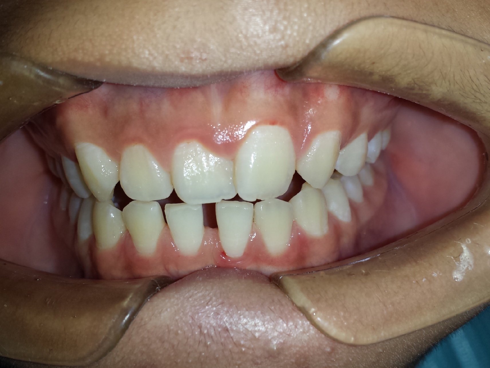 以前不觉得牙缝宽有什么问题,现在一对比,还是整齐的_圈子-新氧美容