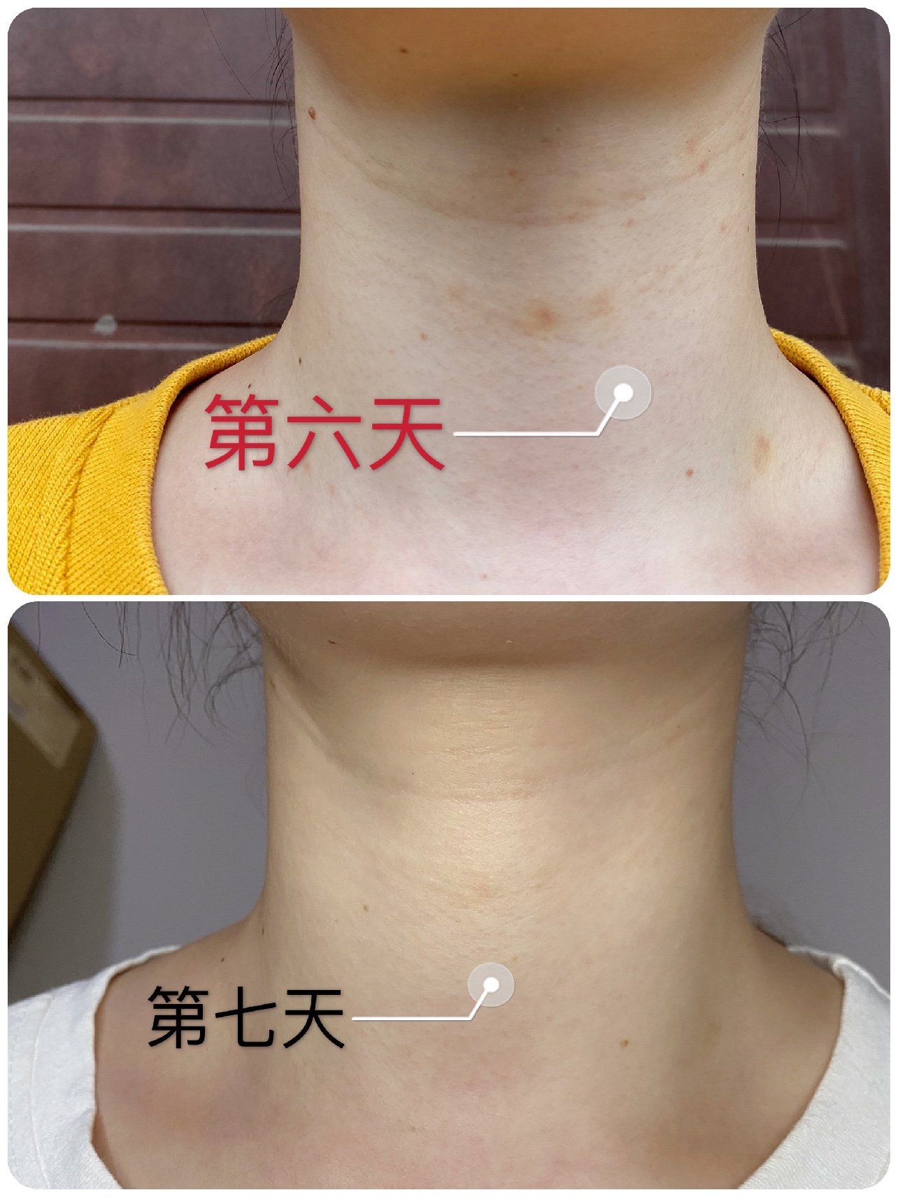 今天我来和大家分享嗨体祛颈纹术后