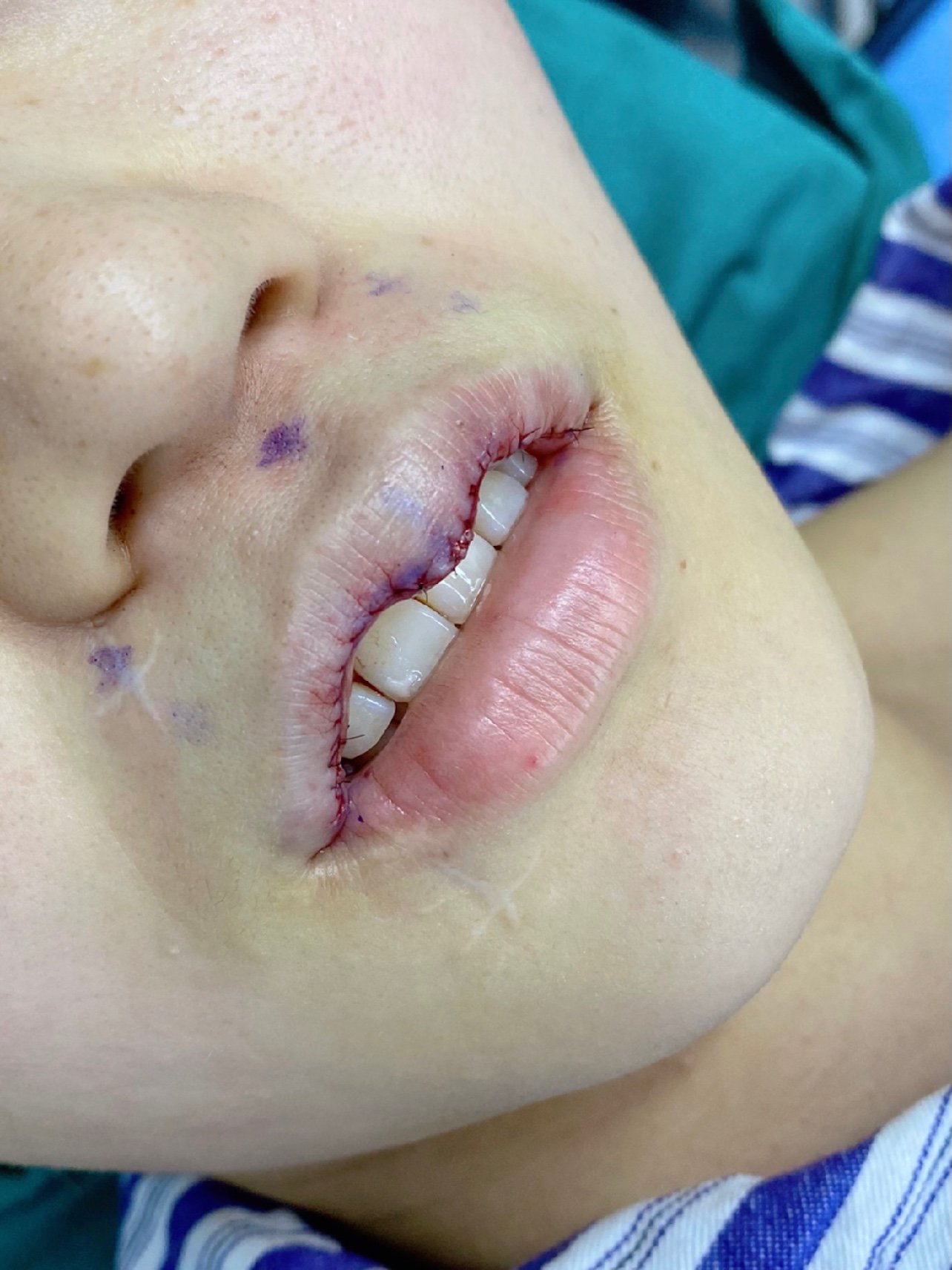 【成都渼淳玉颜】m唇手术