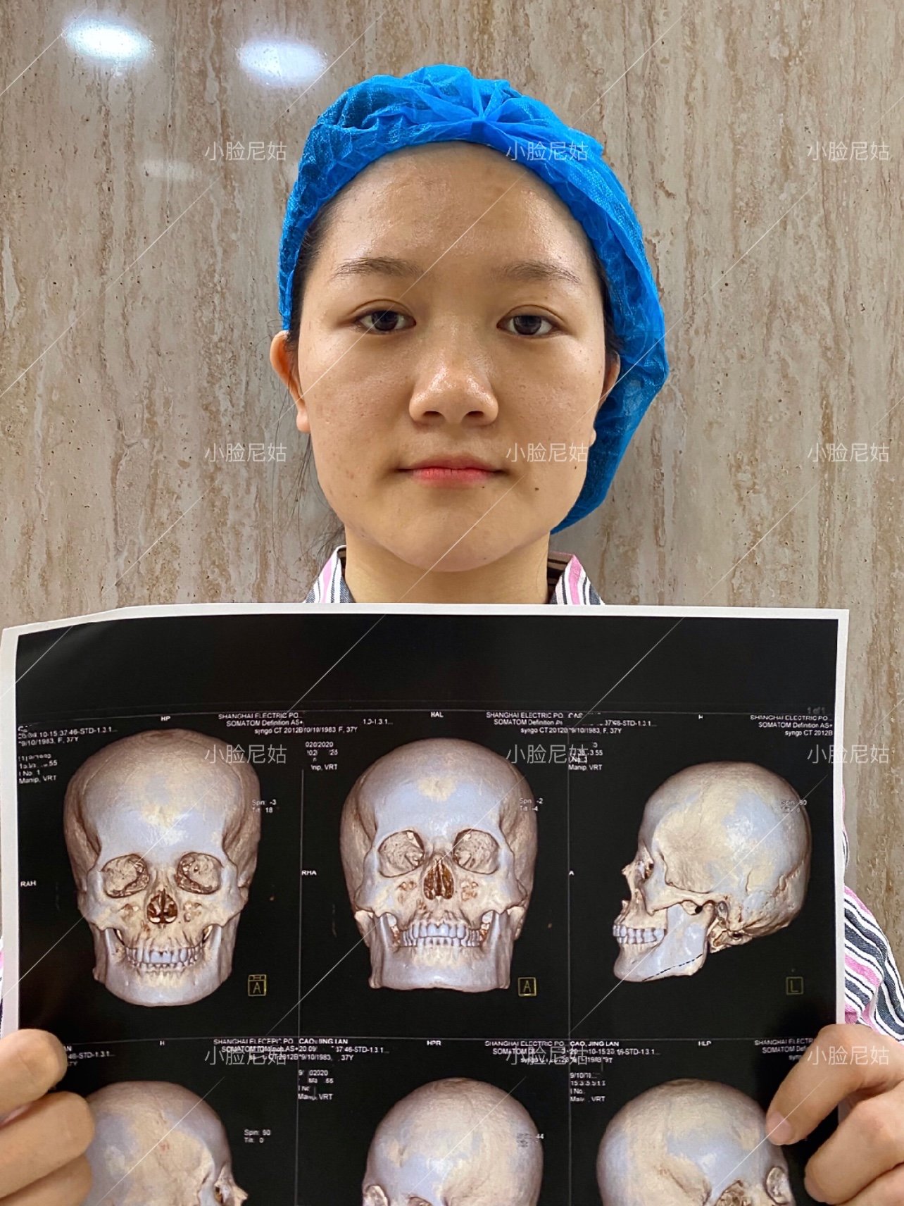 效果情况:我的下颌角比较宽大,它还左右脸不对称,这_圈子-新氧美容