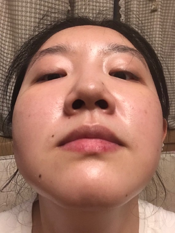 结果左眼变成了这样00突出一块没法化妆没法贴双眼皮贴,不知道是