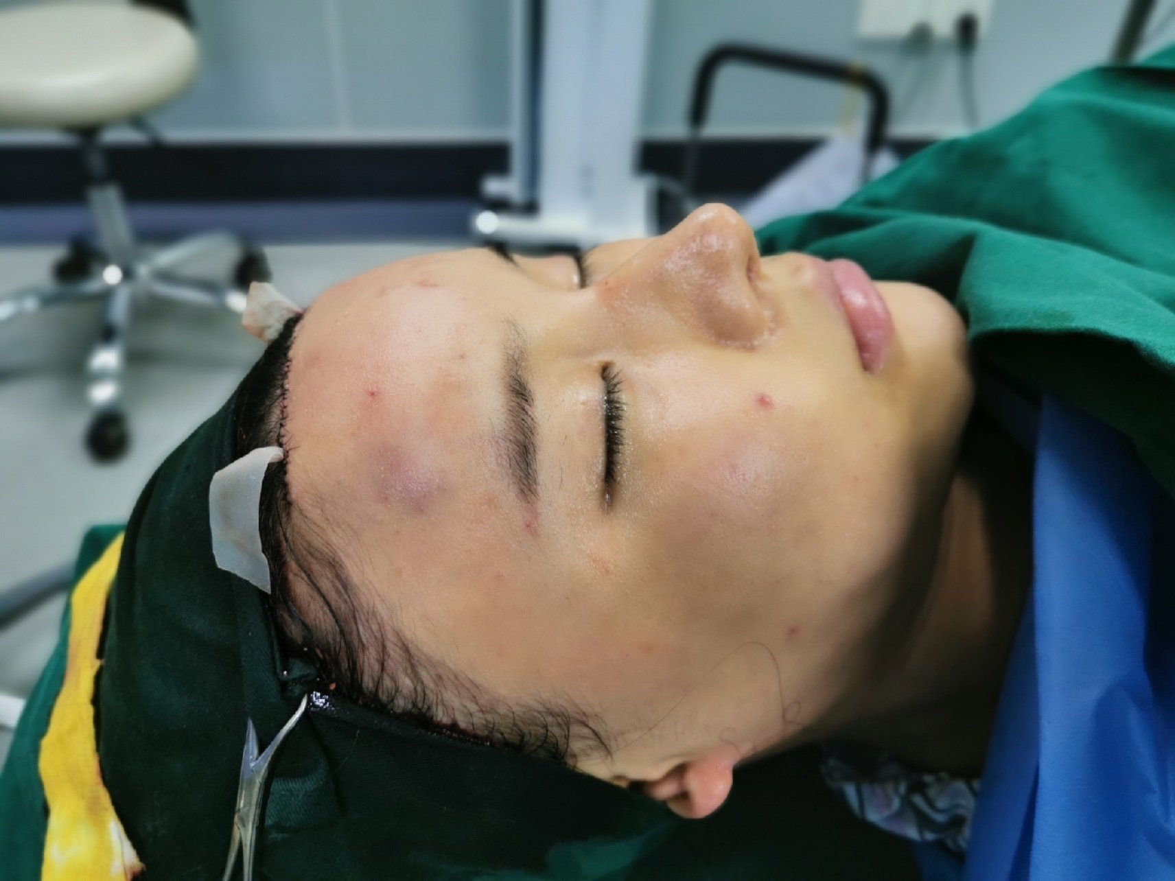 787878额头缩小77术后即刻020202