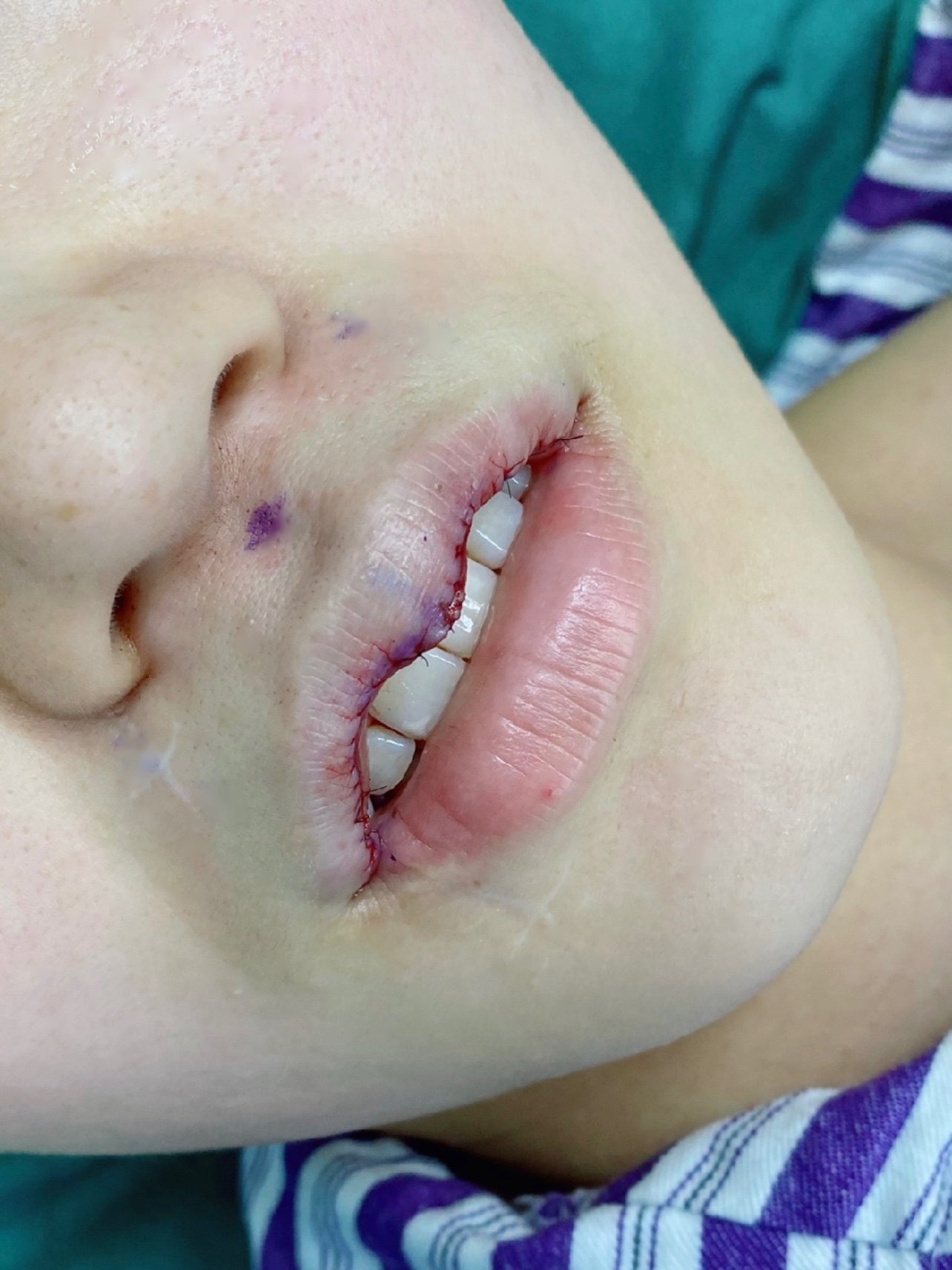 【成都渼淳玉颜】m唇手术