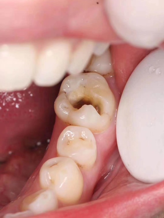 牙齿补得很自然真实,使用了一段时间,感觉很方便,没有使用不适