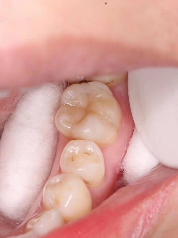 牙齿补得很自然真实,使用了一段时间,感觉很方便,没有使用不适