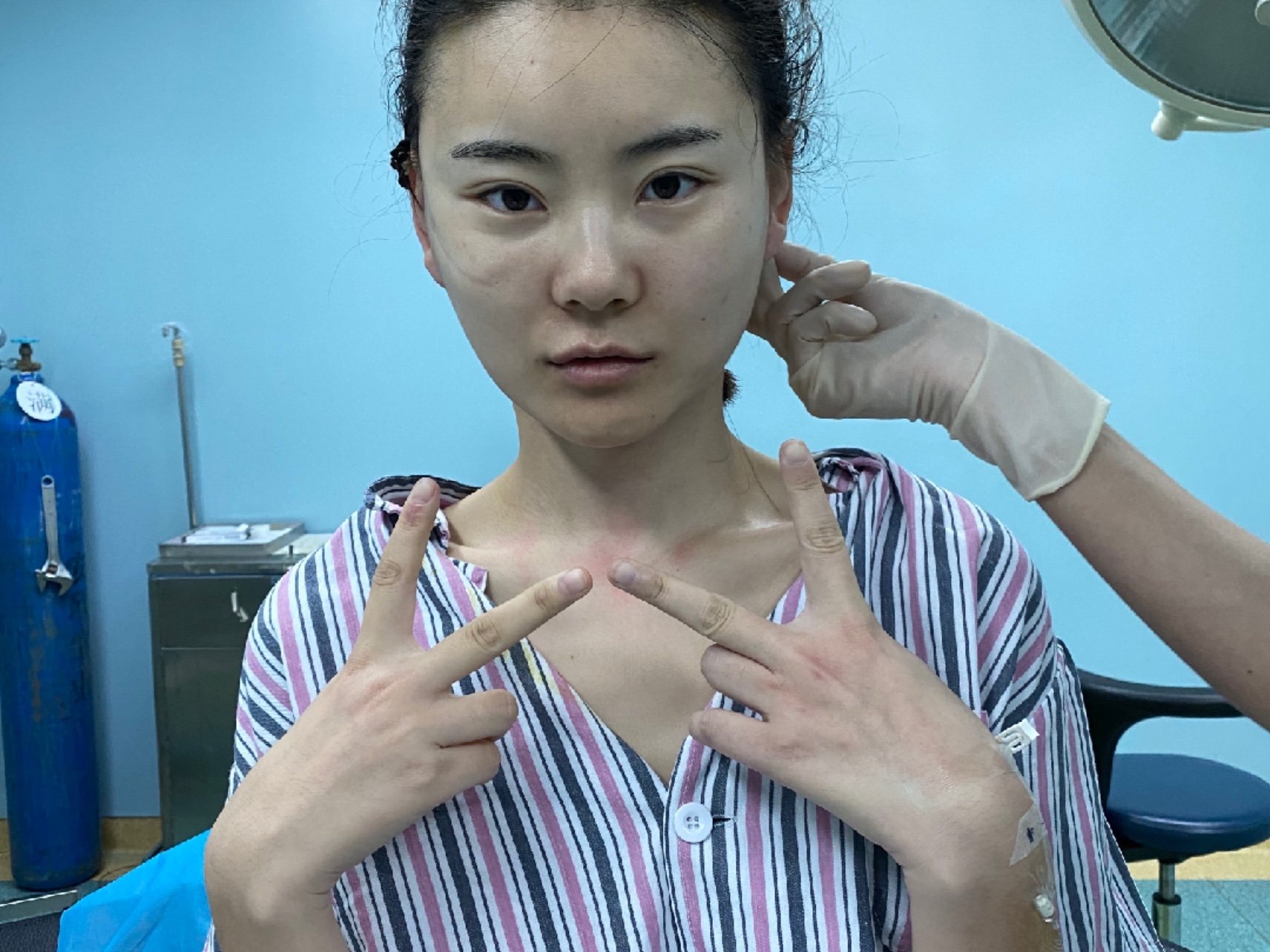 蛋白线面部提升疼不疼_蛋白线面部提升怎么布线_蛋白线面部提升多少钱