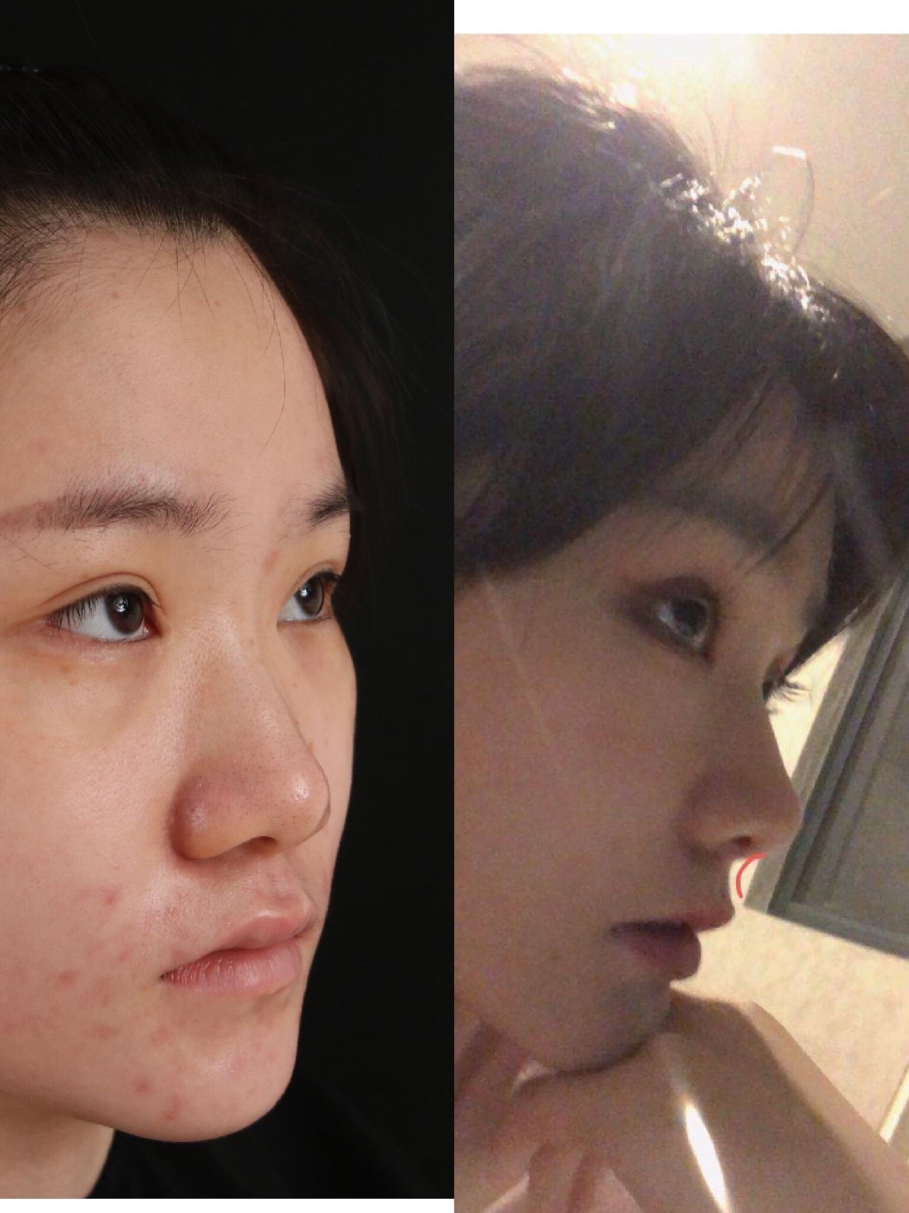先报个方案:膨体 半肋 鼻基底 眉心三角填充,然后_圈子-新氧美容整形