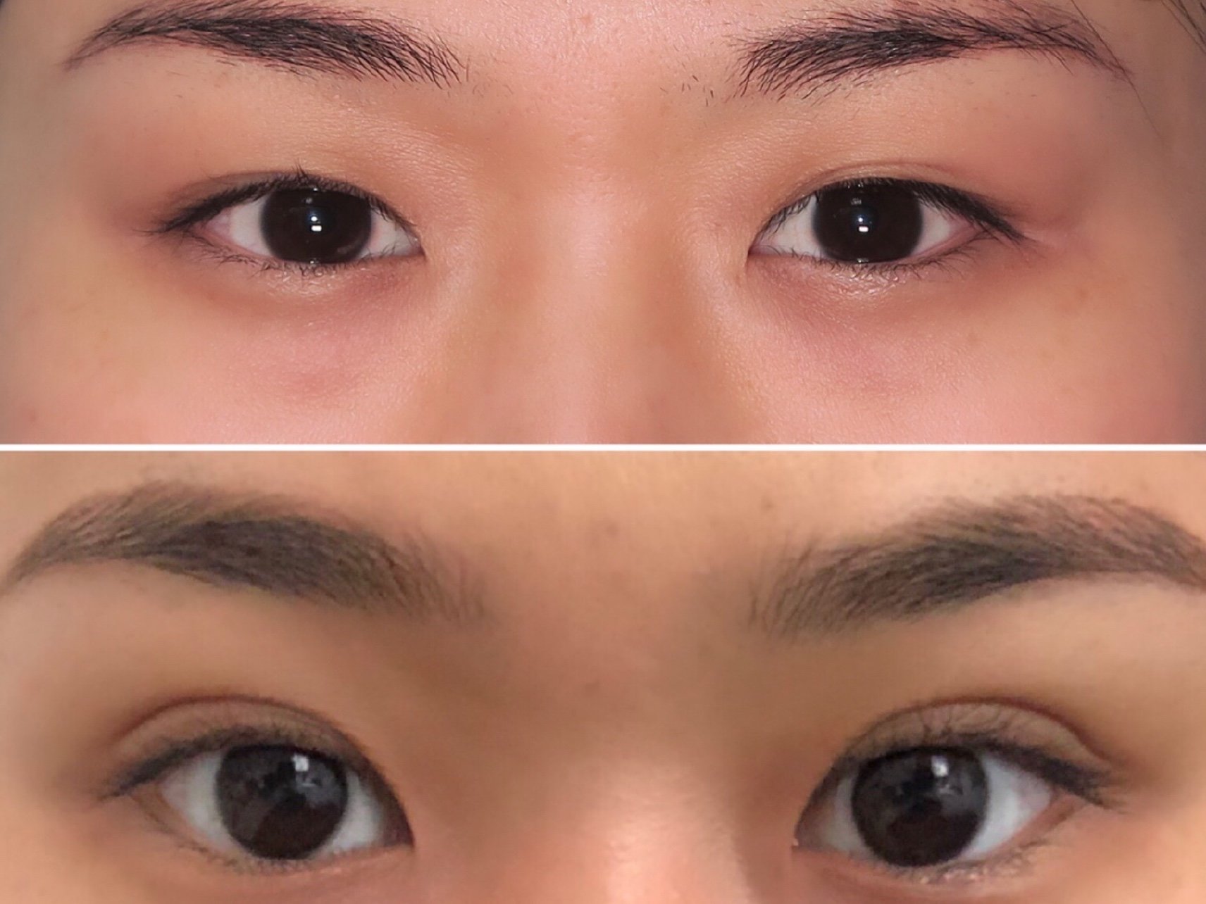 【术前诊断】:双眼皮较窄【方案设计】:建议全切双眼_圈子-新氧美容