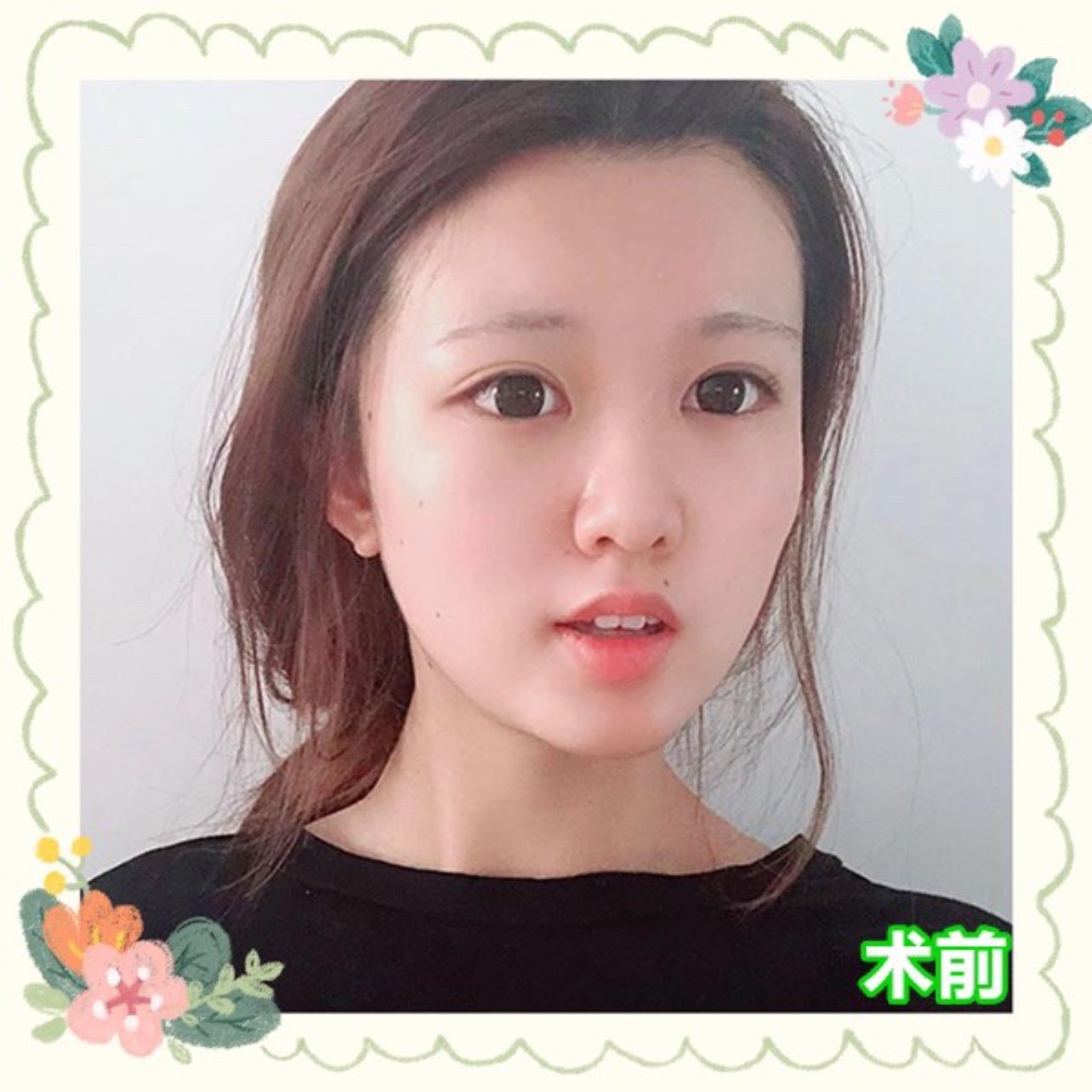 好看的鼻子不只是高鼻梁 鼻部整形的标准是什么?