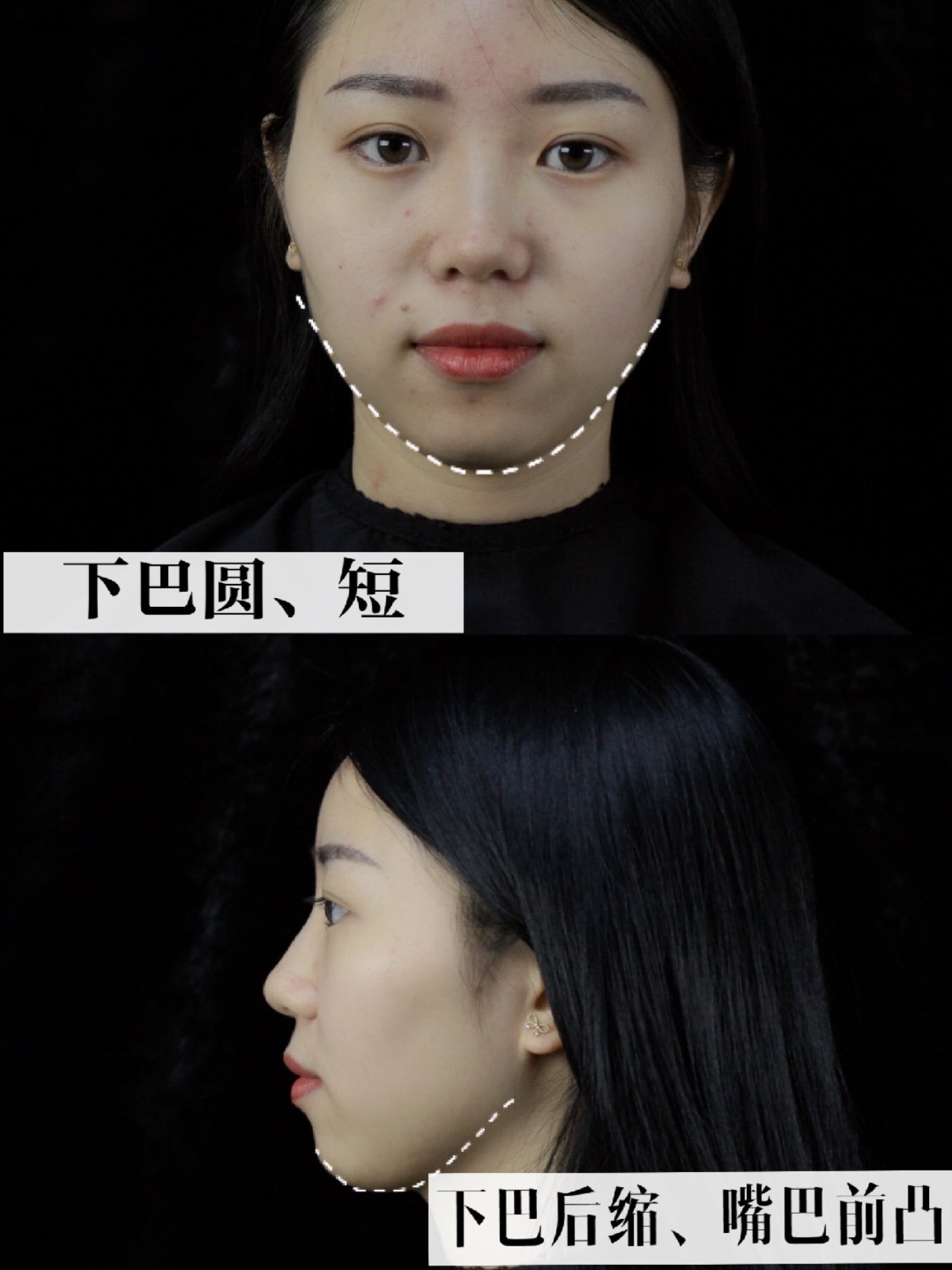 你离小v翘下巴只差一支玻尿酸