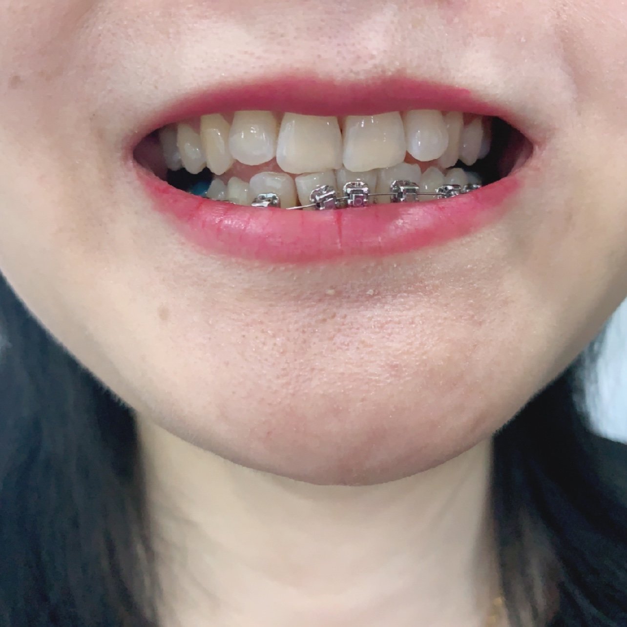 下牙整齐了 开始要收缝了 但是黑三角蛮严重的 有点_圈子-新氧美容