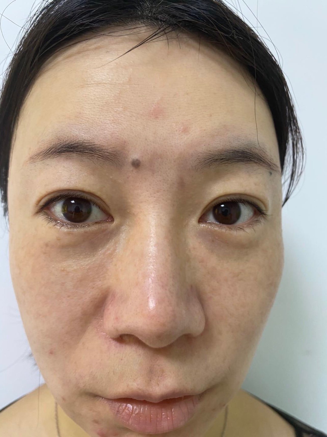 第一次做眼部的热玛吉,科普了很多热玛吉的知识,也是