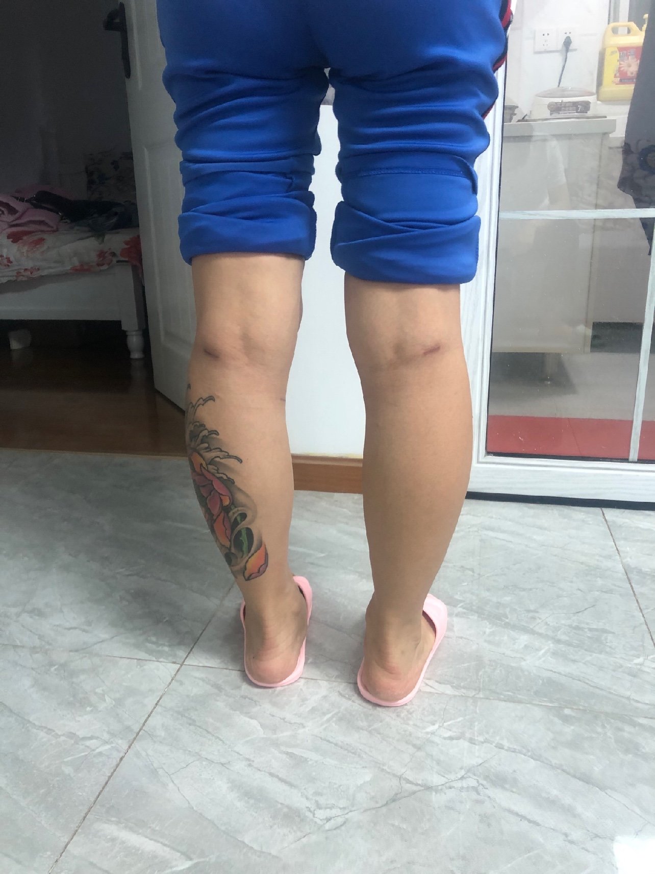 已经术后2个月了,现在小腿的线条好看很多了,前几天_圈子-新氧美容