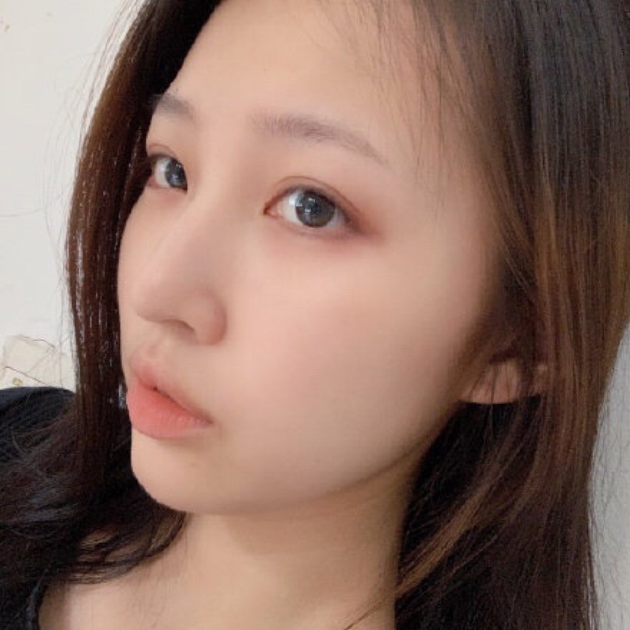 很自然,平时不化妆的时候看着也不假,恢复的真的很好_圈子-新氧美容