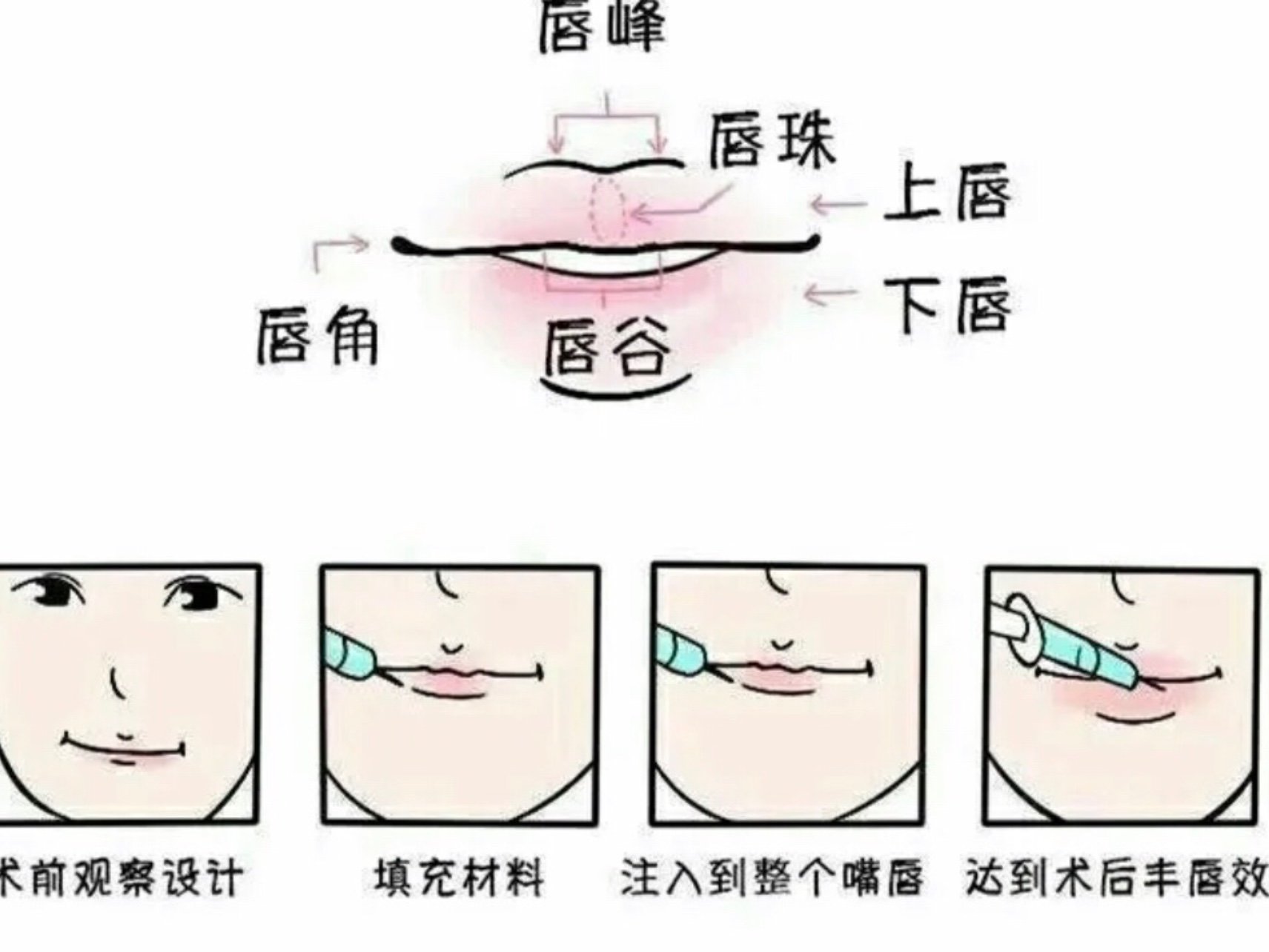 玻尿酸丰唇 唇形多种多样,也是五官中容易改变的部分,只要适当微调