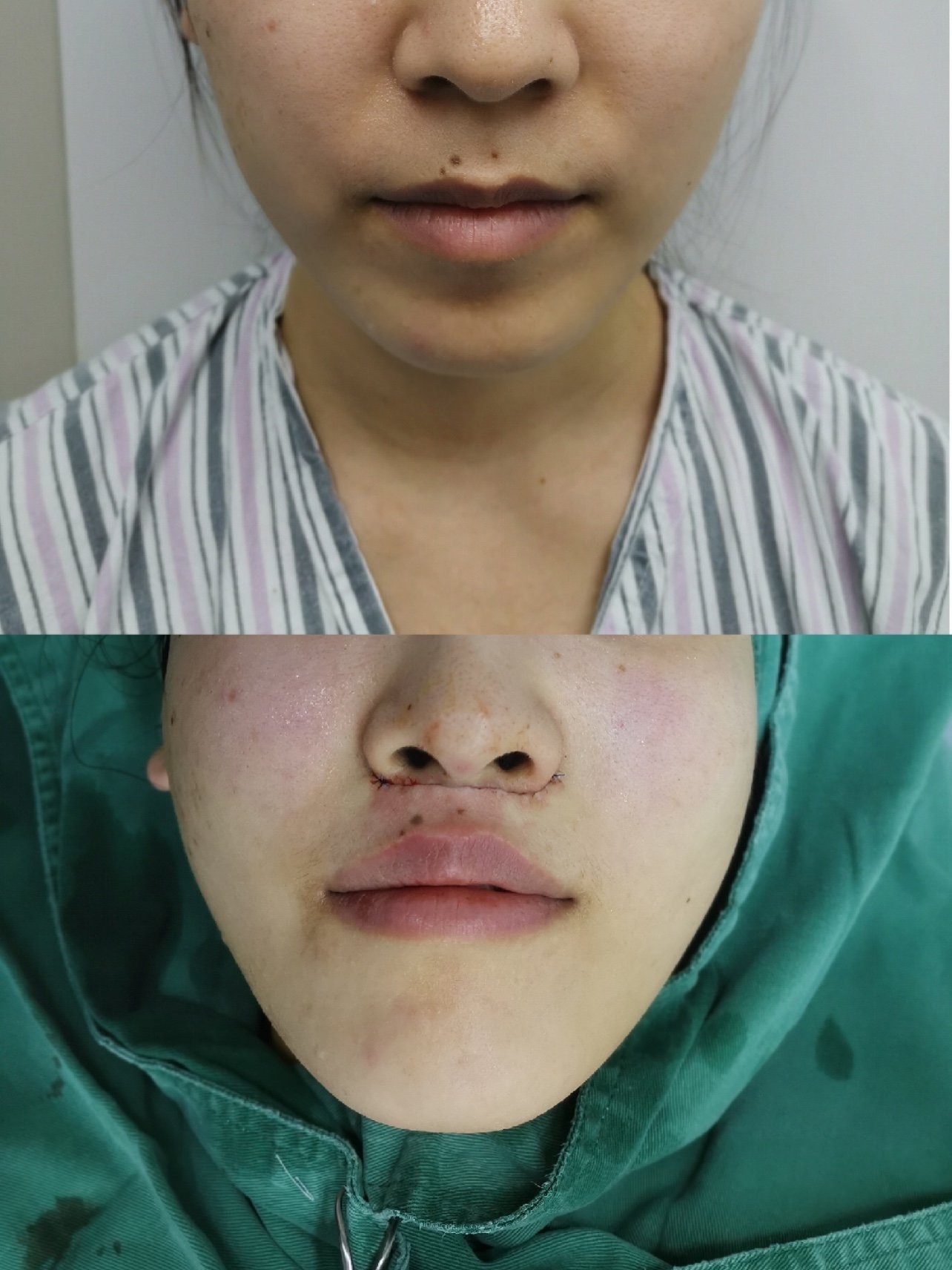 人中缩短年轻术术后第一天