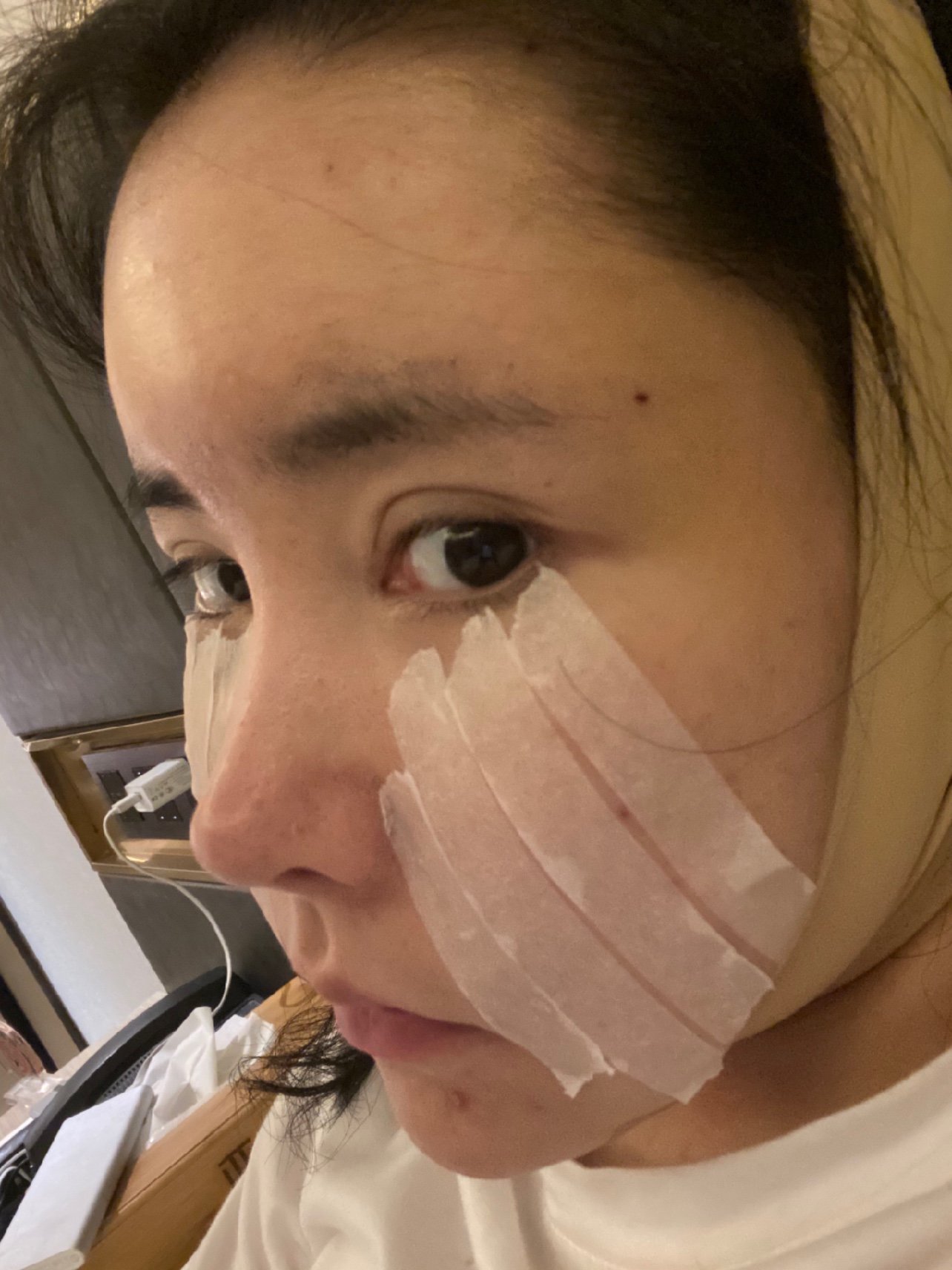脂肪填充第四天,还有些肿.这额头感觉填多了吧?
