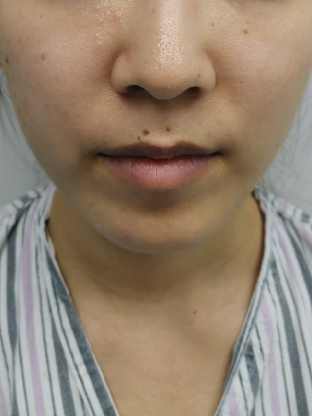 人中缩短年轻术术后第一天