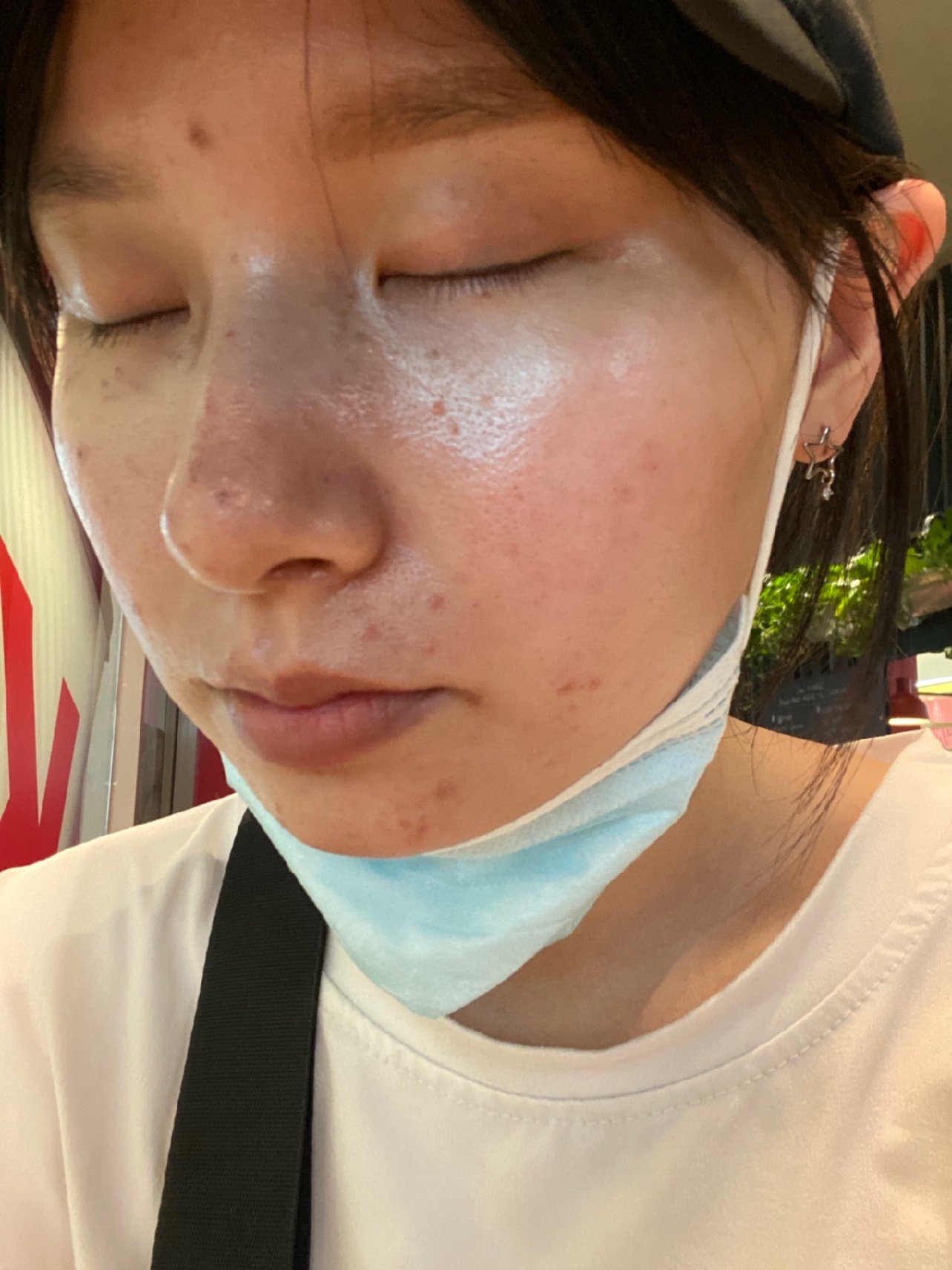 皮秒激光第一天,10月2号_圈子-新氧美容整形