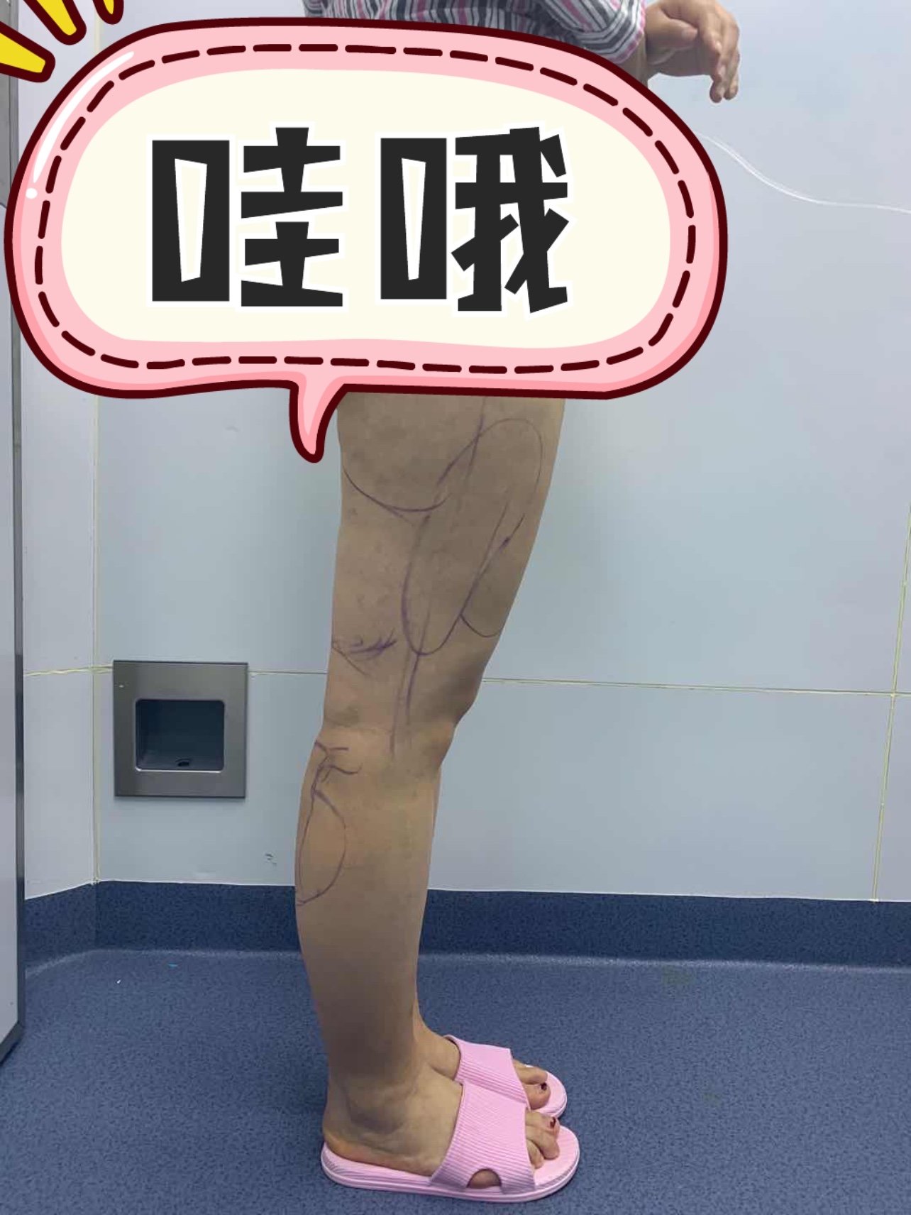 大腿吸脂77小腿吸脂术前